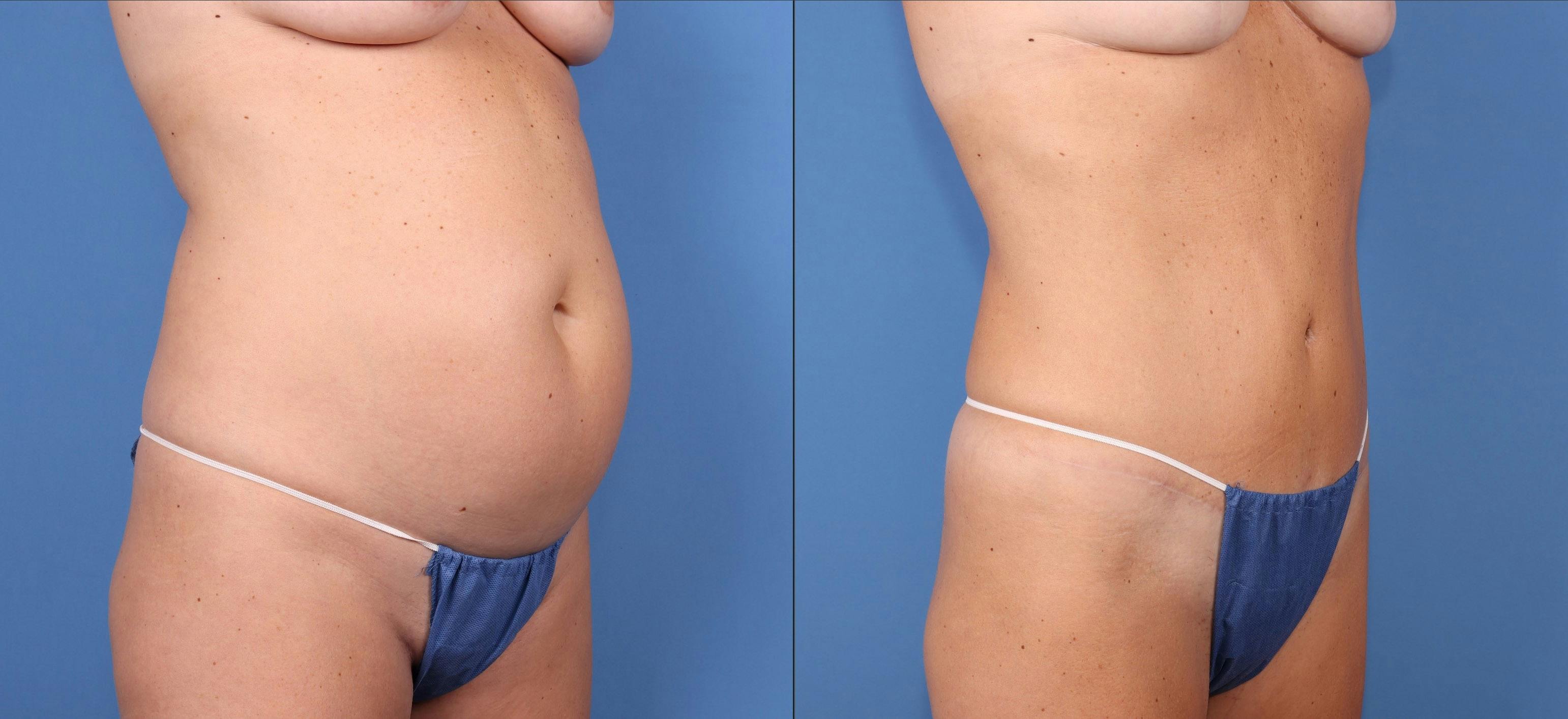 Abdomen Before & After Gallery - Patient 693186 - Image 2