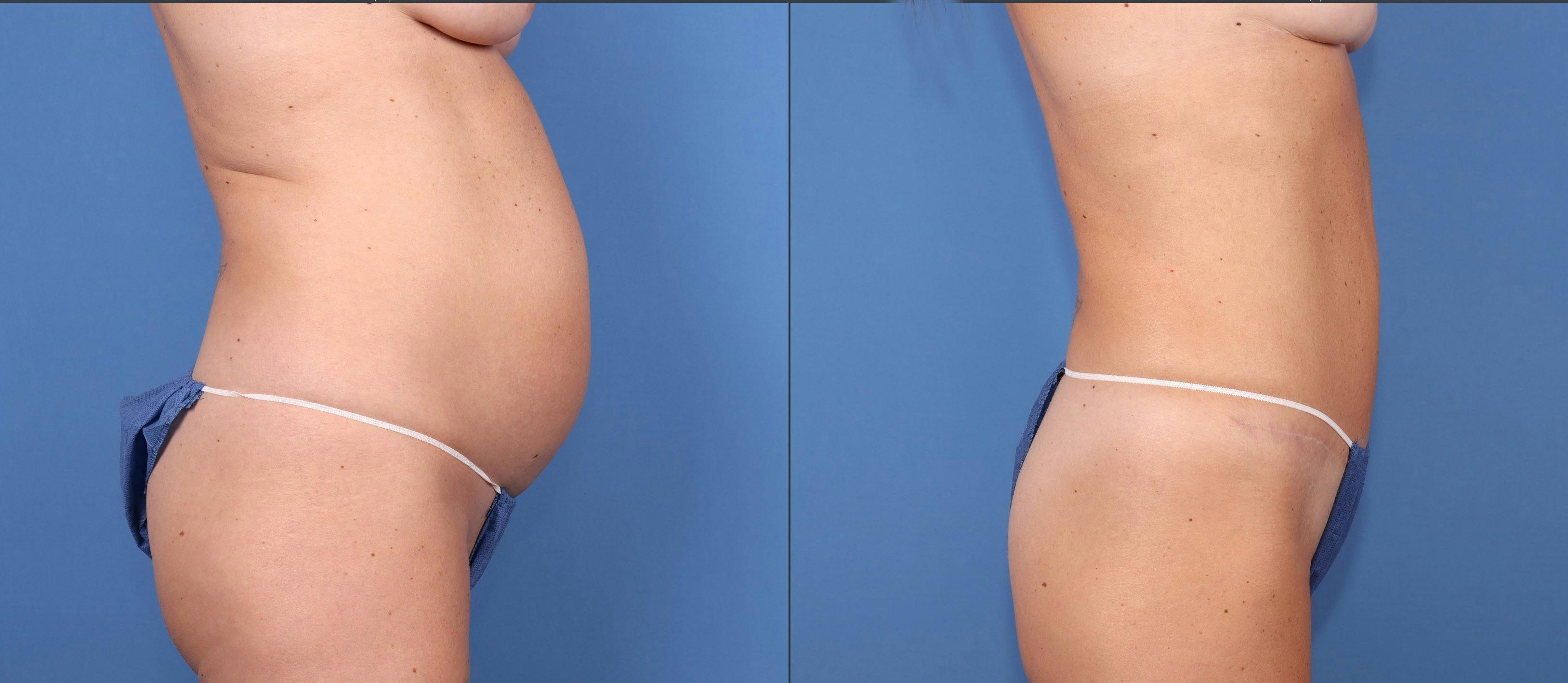 Abdomen Before & After Gallery - Patient 693186 - Image 3