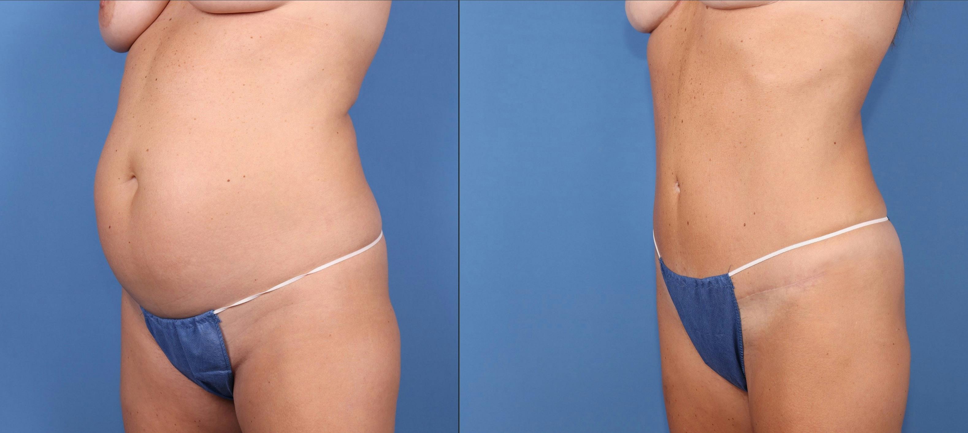 Abdomen Before & After Gallery - Patient 693186 - Image 4