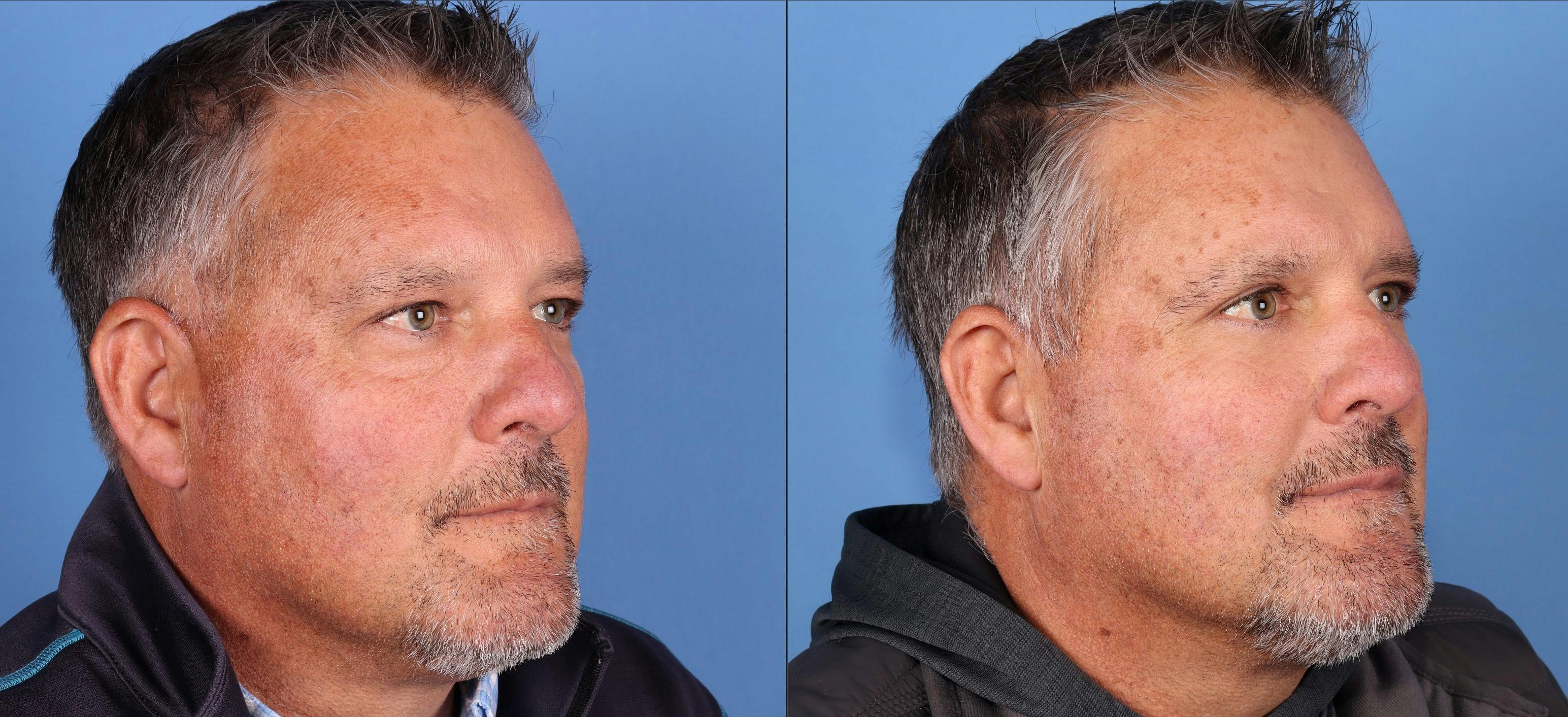 Facial Fillers Before & After Gallery - Patient 545768 - Image 2