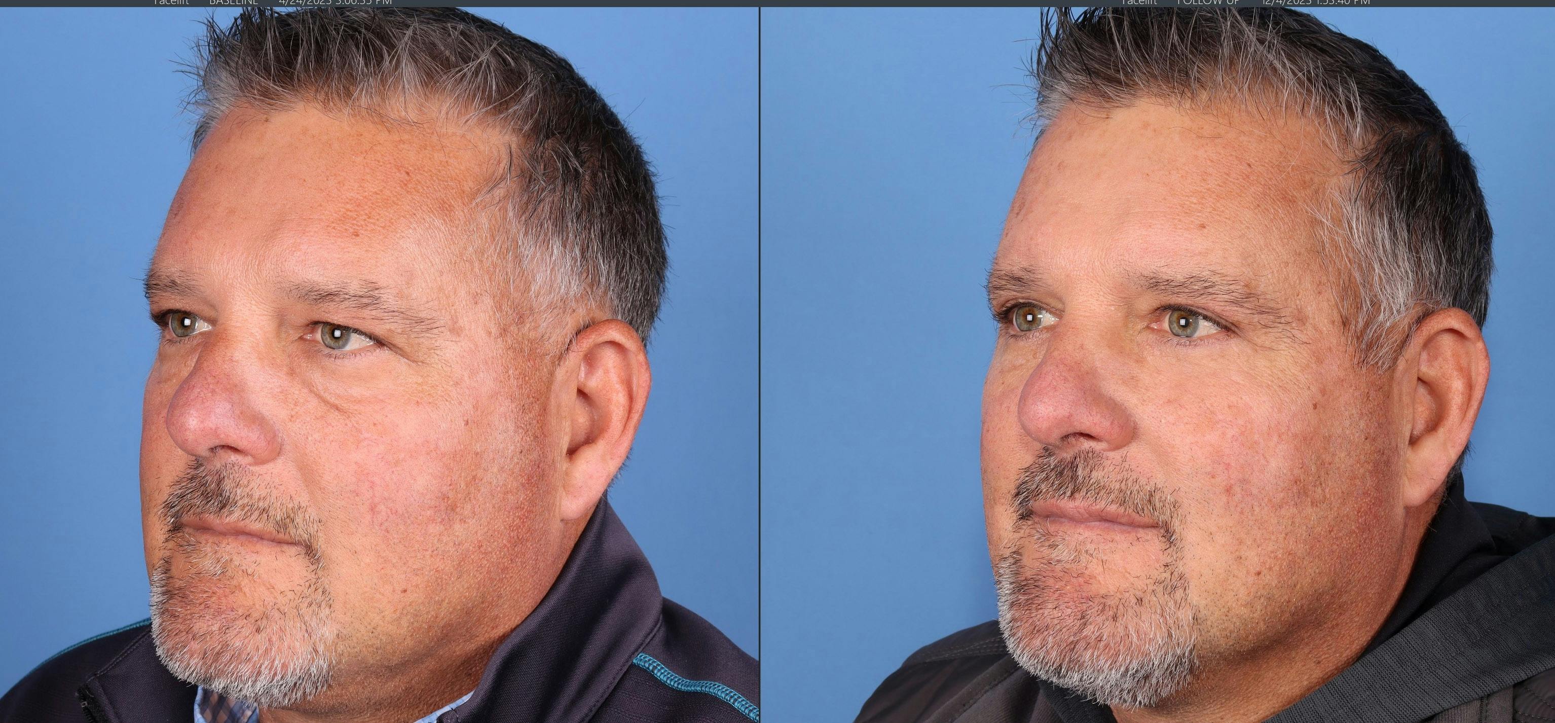 Eyelid Surgery Before & After Gallery - Patient 862528 - Image 3