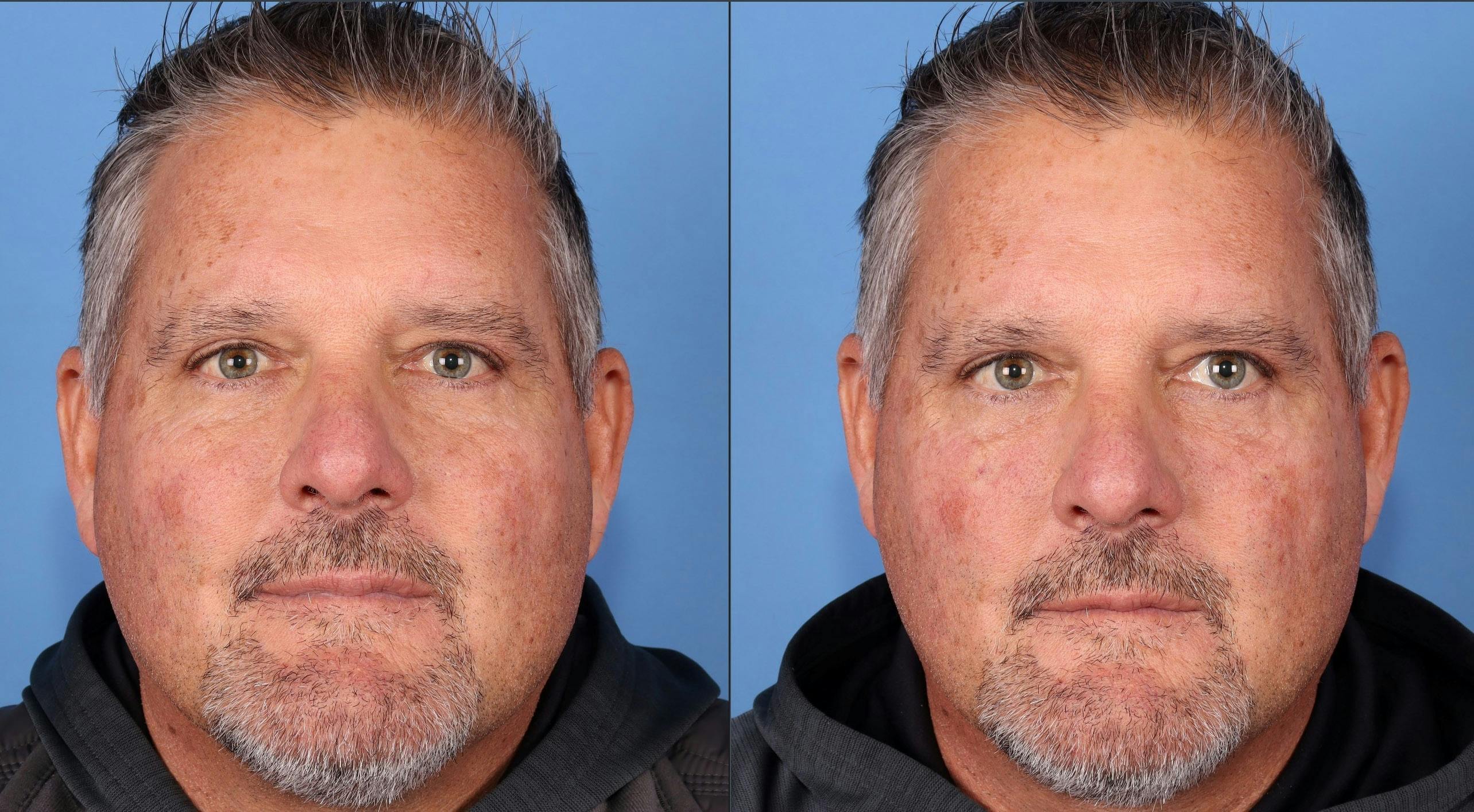 Facial Fillers Before & After Gallery - Patient 545768 - Image 1