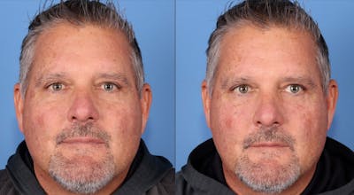 Eyelid Surgery (Upper & Lower Blepharoplasty) Before & After Gallery - Patient 421528 - Image 1
