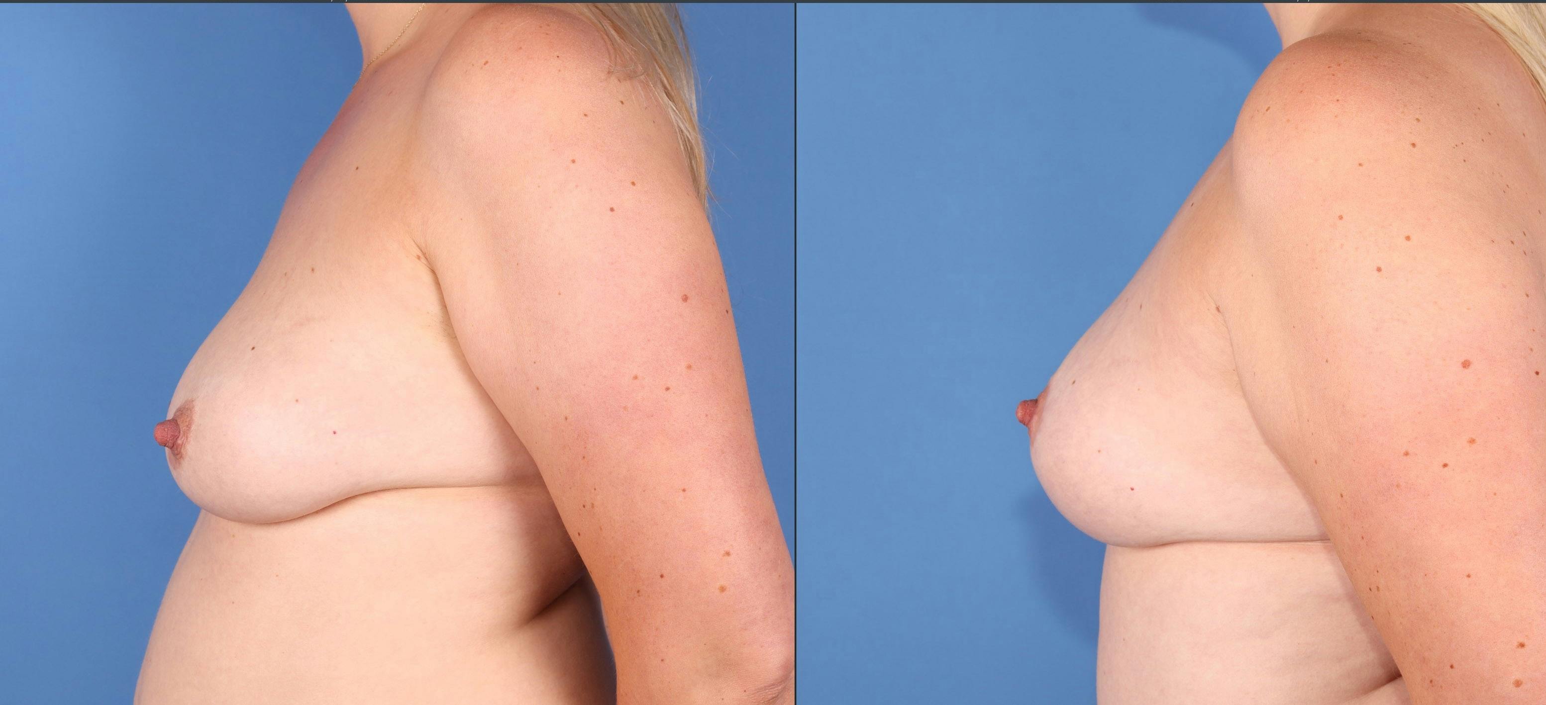 Breast Lift Before & After Gallery - Patient 191065 - Image 5