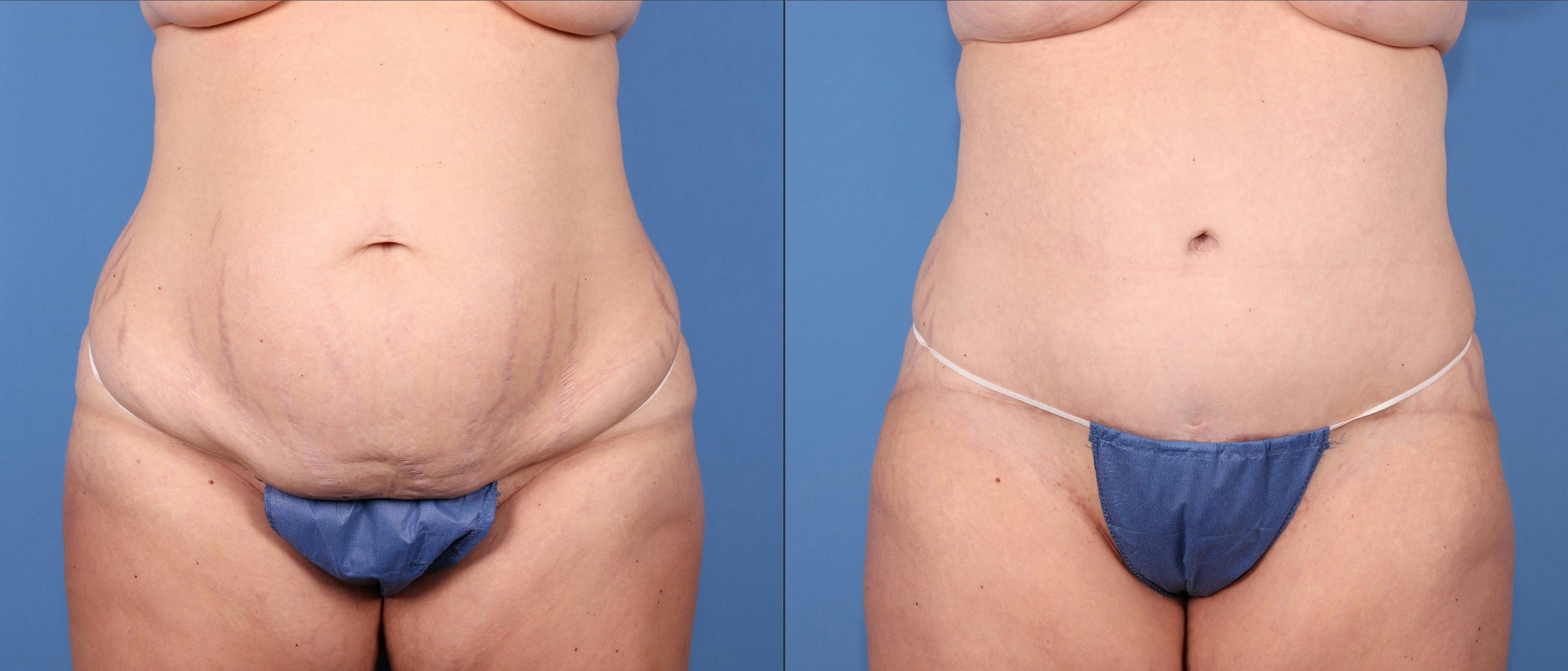 Abdomen Before & After Gallery - Patient 418414 - Image 1