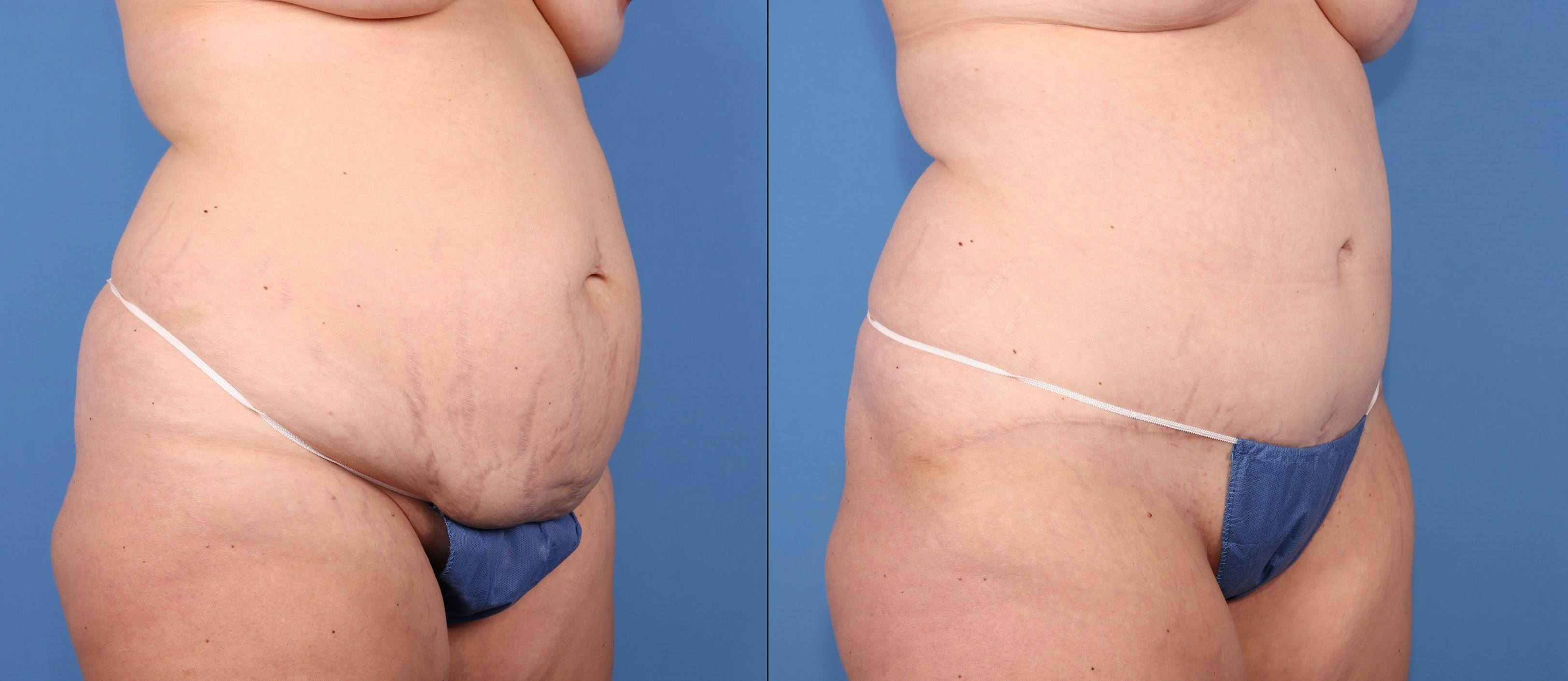 Abdomen Before & After Gallery - Patient 418414 - Image 2