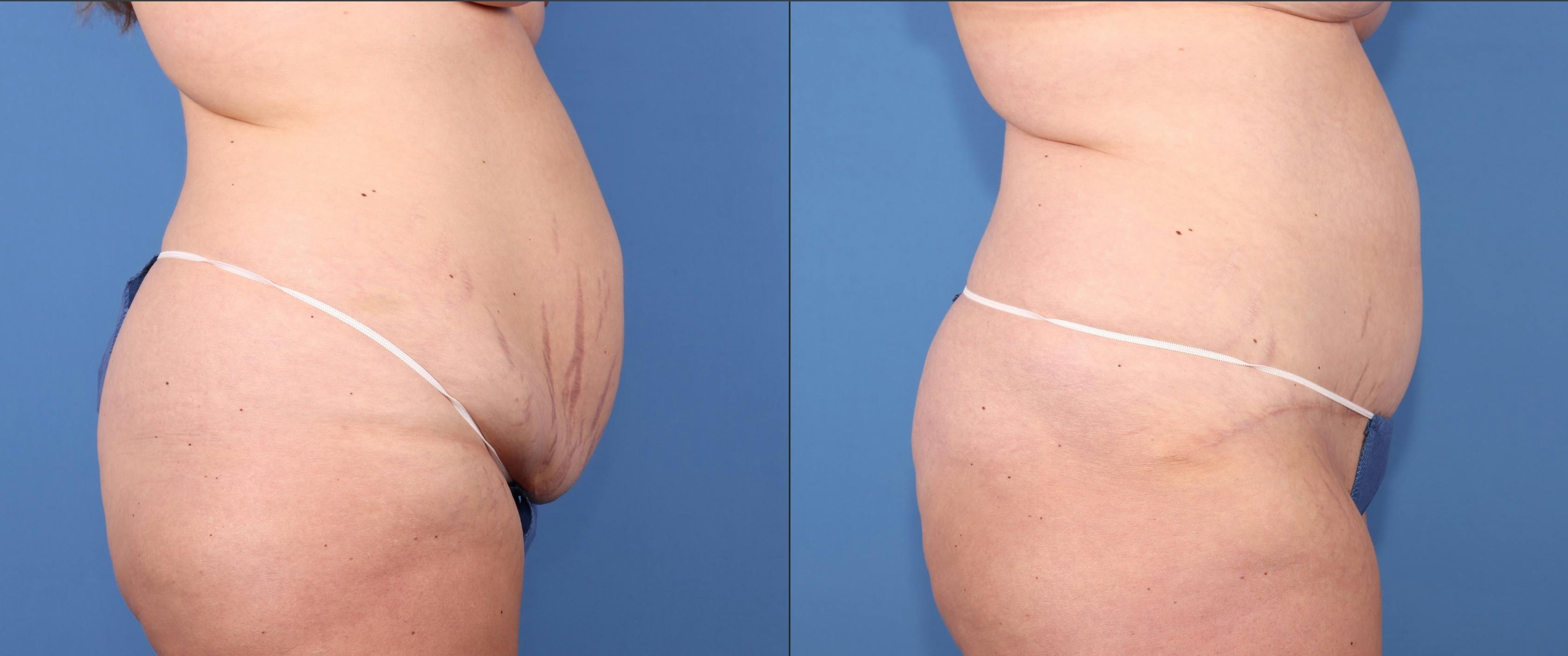 Abdomen Before & After Gallery - Patient 418414 - Image 3