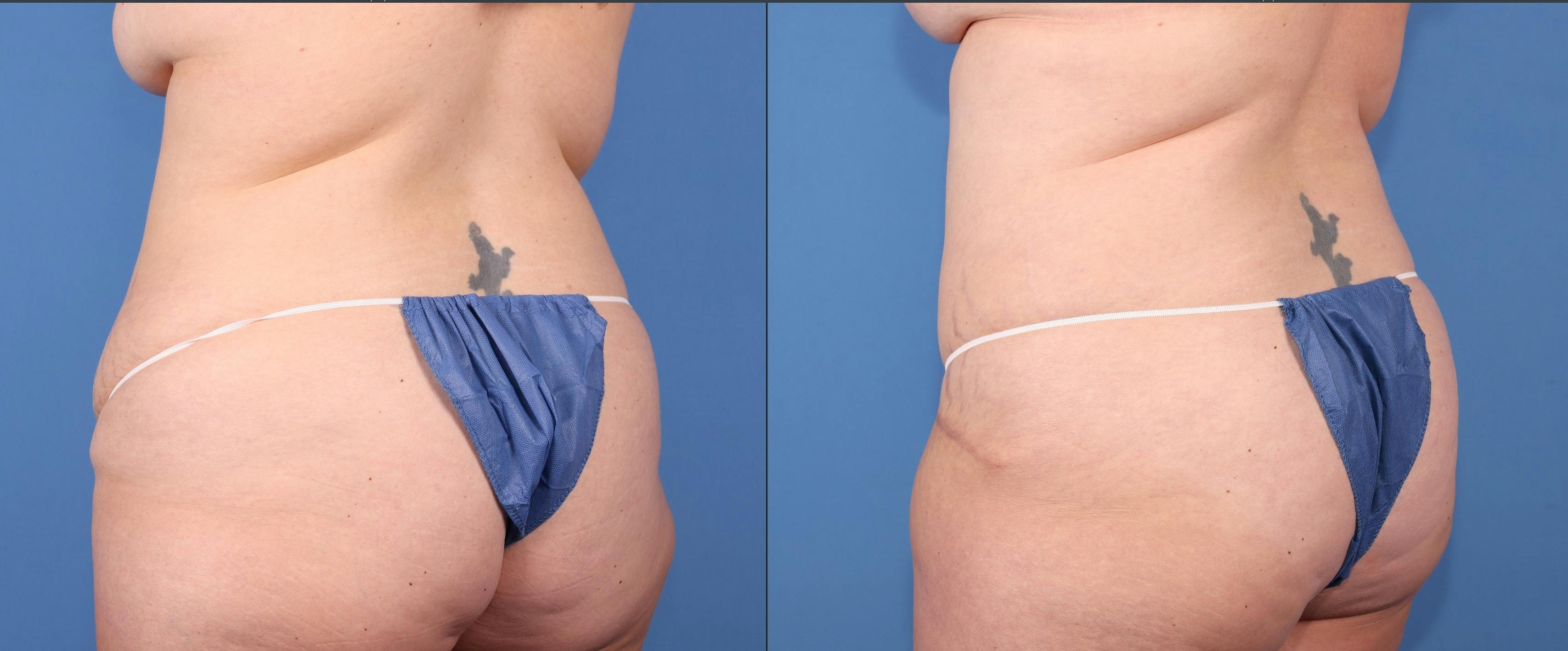 Abdomen Before & After Gallery - Patient 418414 - Image 4