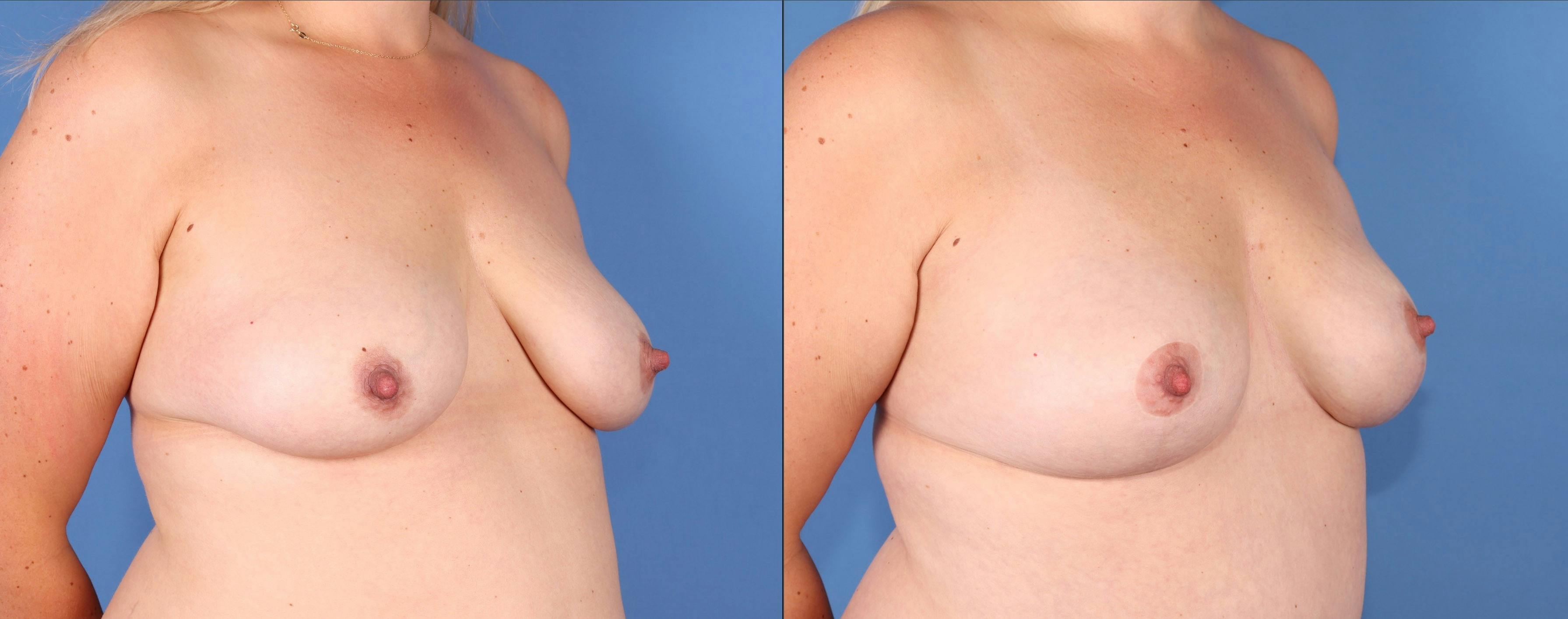 Breast Lift Before & After Gallery - Patient 191065 - Image 2