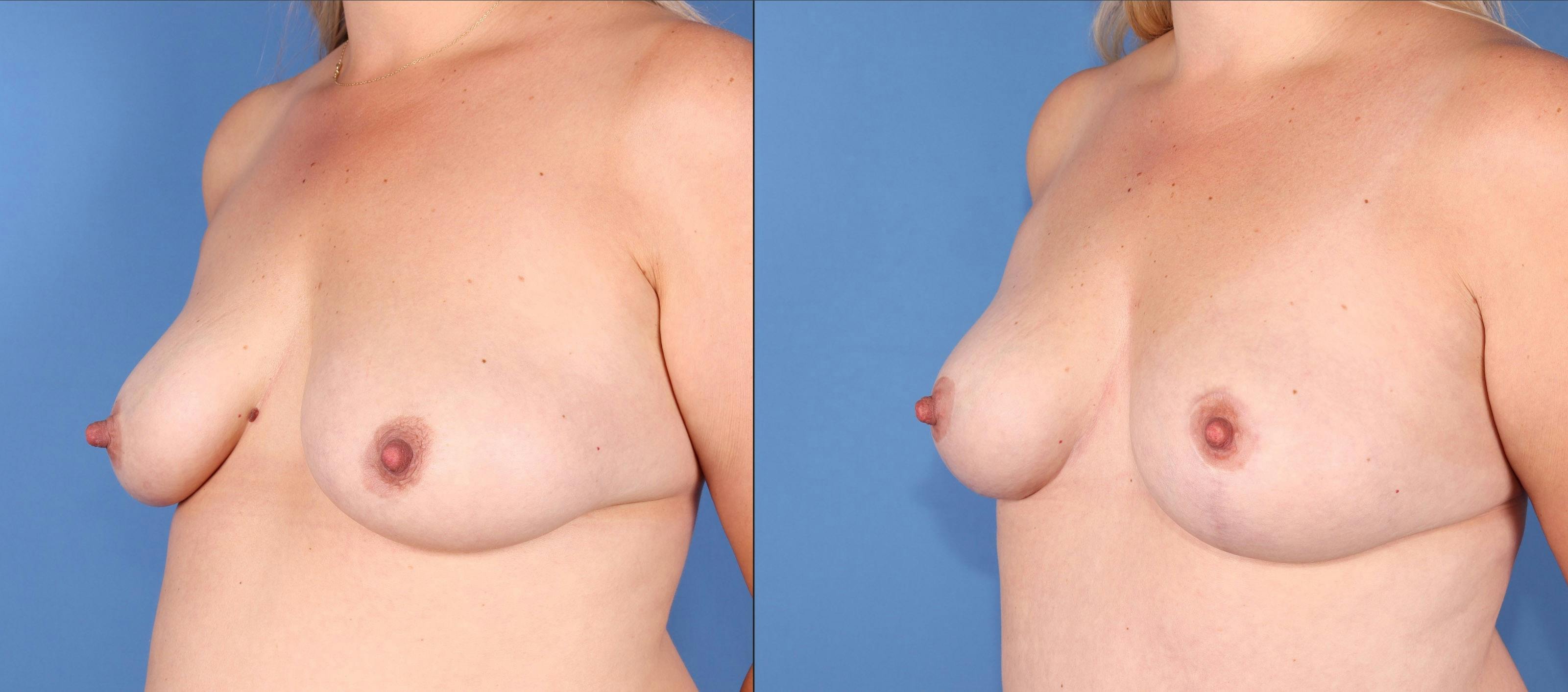 Fat Transfer Breast Augmentation Before & After Gallery - Patient 348755 - Image 4