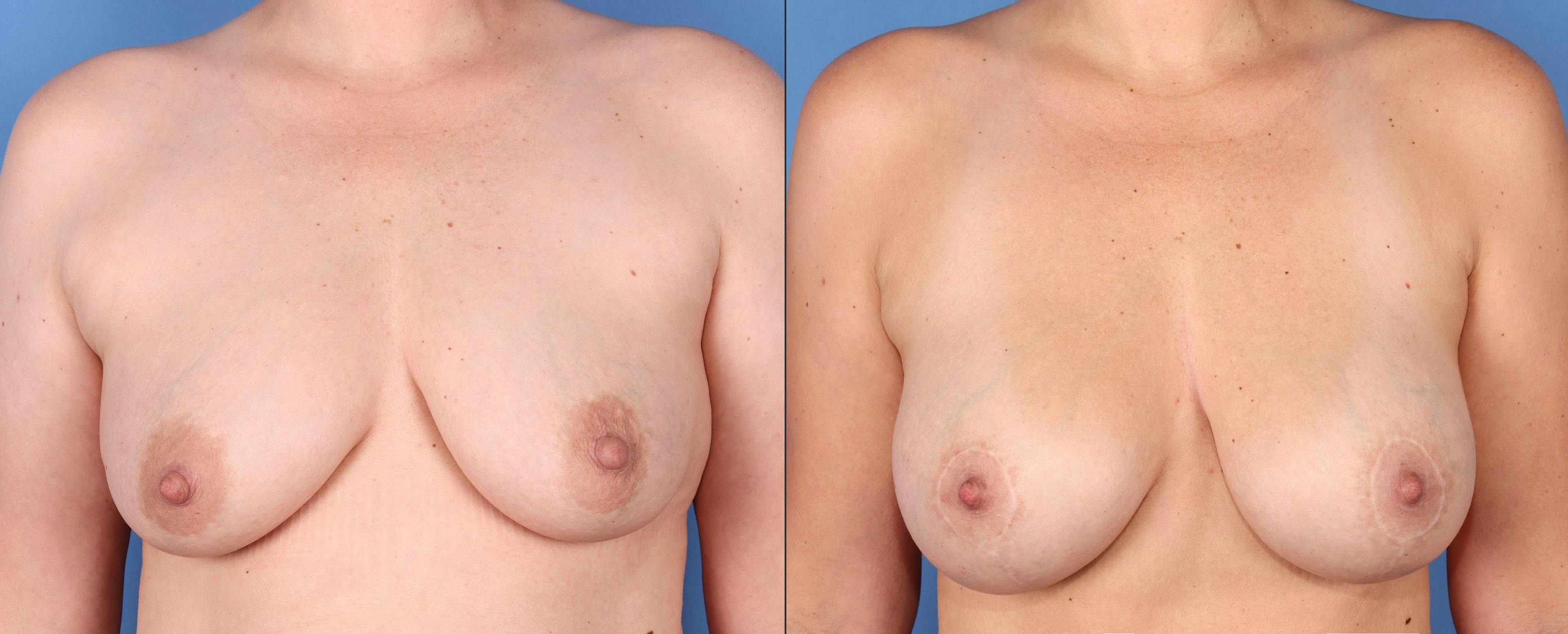 Breast Lift with Augmentation Before & After Gallery - Patient 316347 - Image 1
