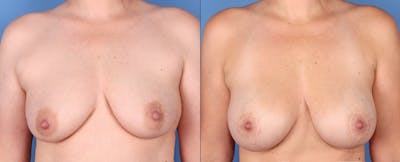 Breast Lift with Augmentation Before & After Gallery - Patient 316347 - Image 1