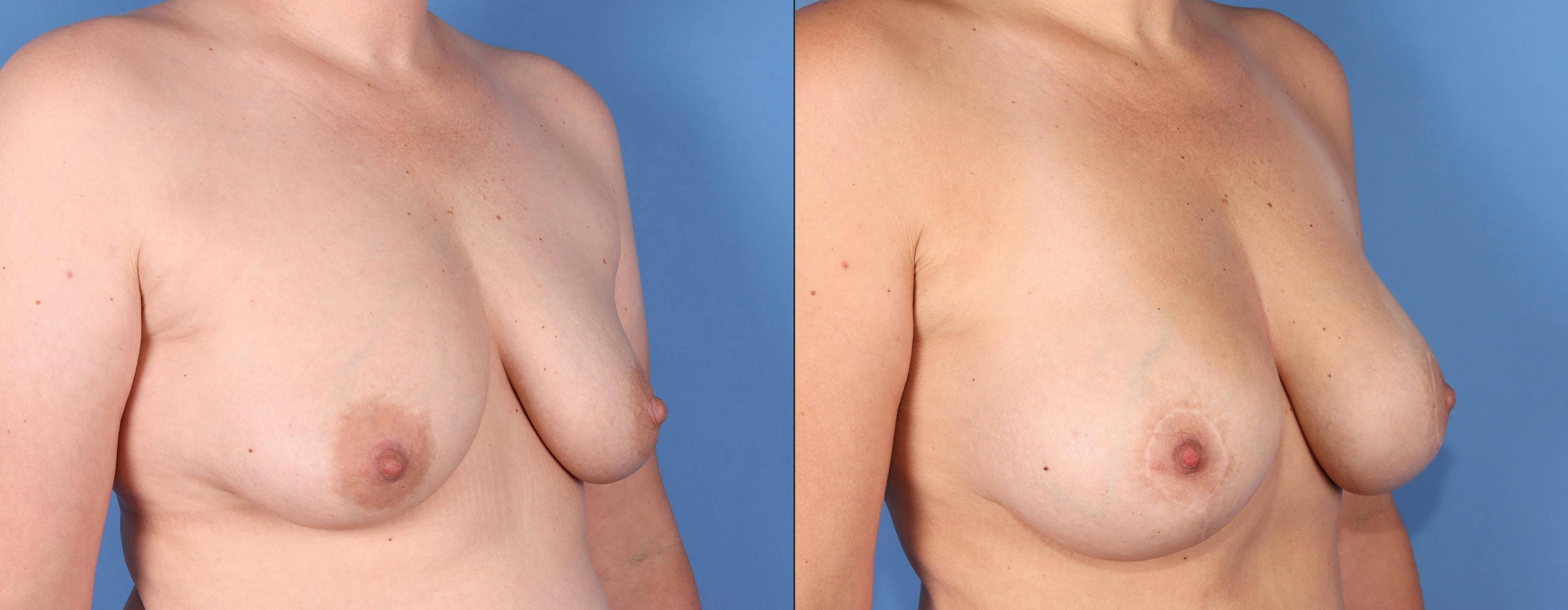 Breast Lift with Augmentation Before & After Gallery - Patient 316347 - Image 2