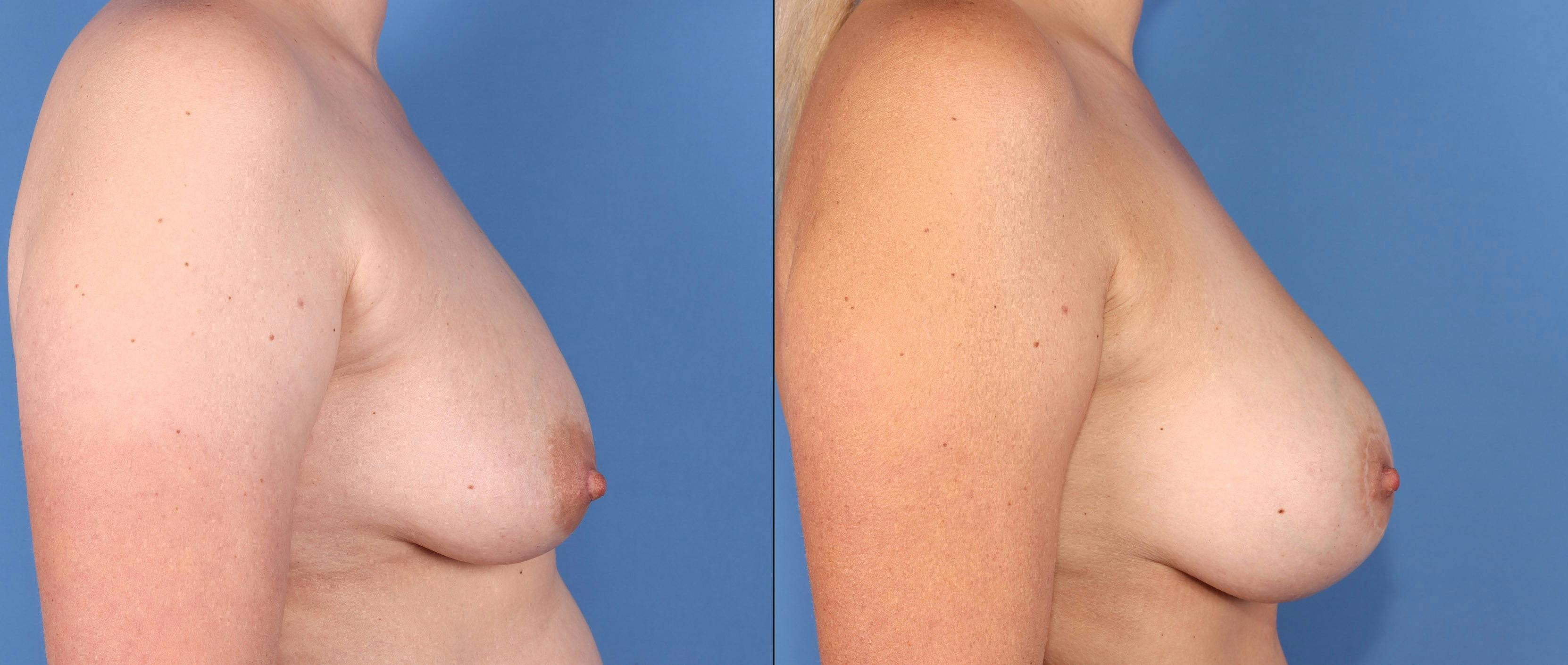 Breast Lift with Augmentation Before & After Gallery - Patient 316347 - Image 3