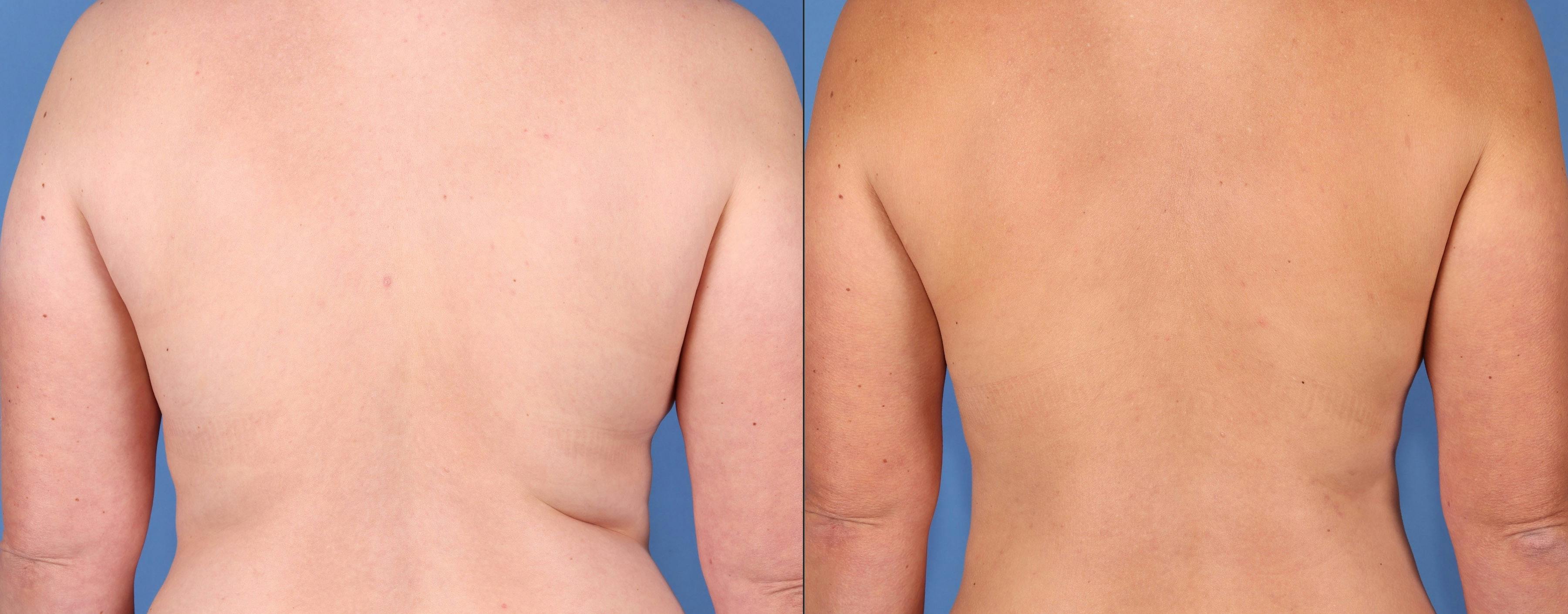 Abdomen Before & After Gallery - Patient 187164 - Image 6