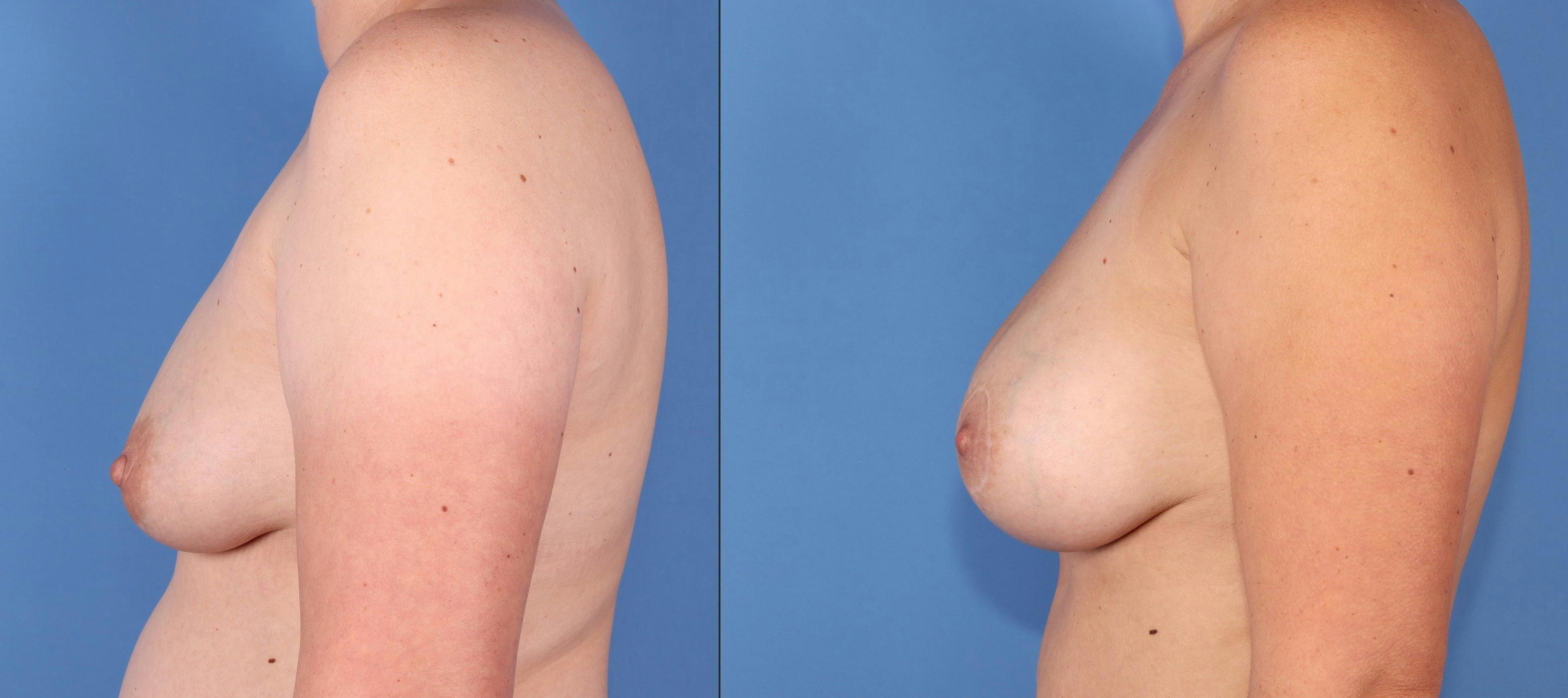 Breast Lift with Augmentation Before & After Gallery - Patient 316347 - Image 4
