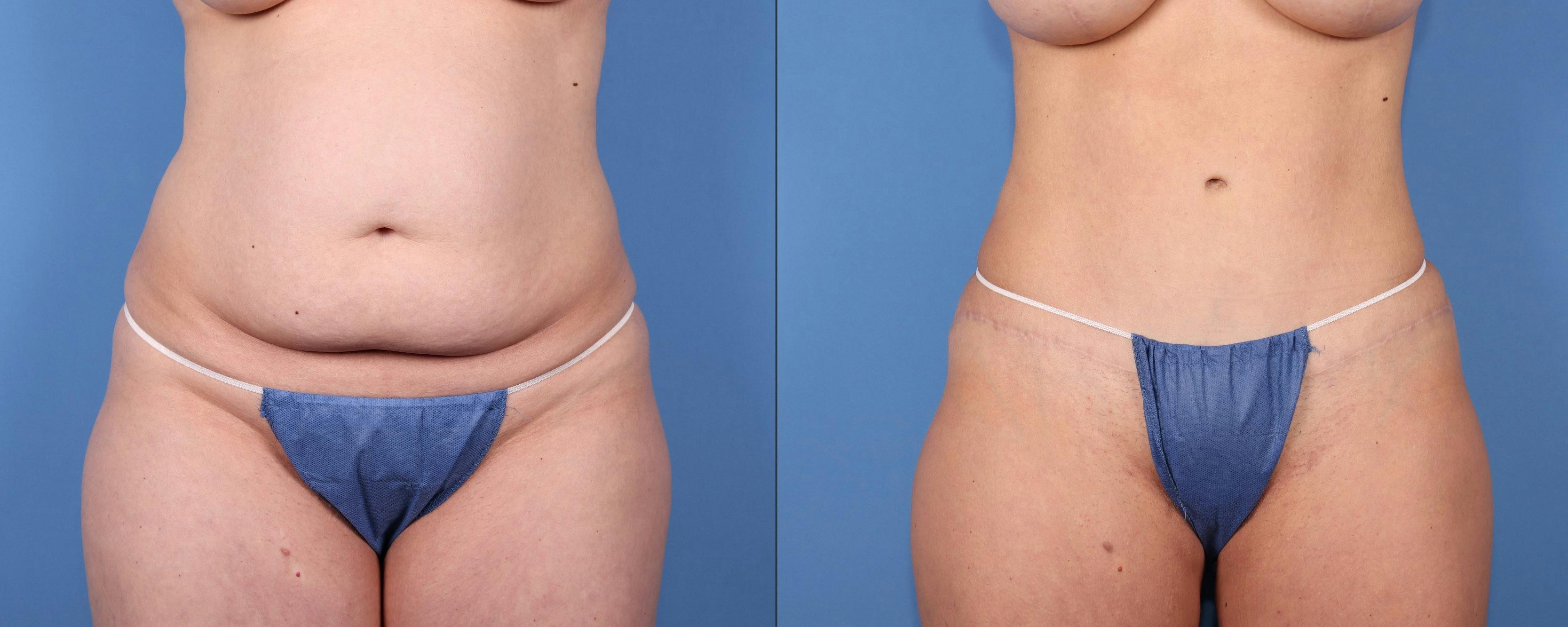 Tummy Tuck Before & After Gallery - Patient 126912 - Image 1