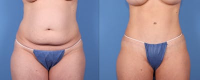Tummy Tuck Before & After Gallery - Patient 126912 - Image 1