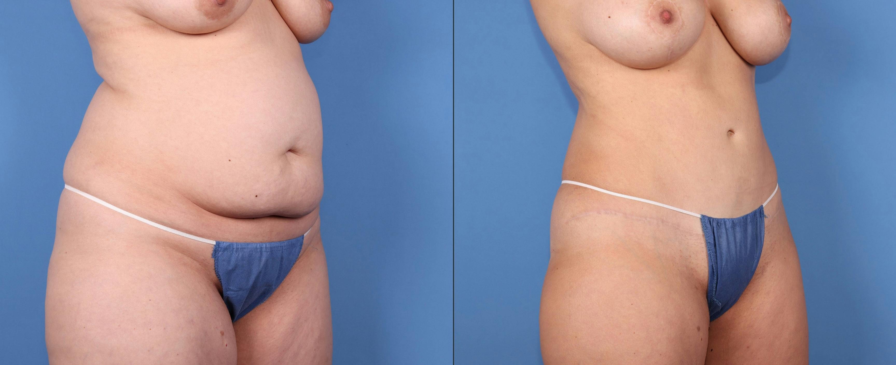 Tummy Tuck Before & After Gallery - Patient 126912 - Image 2