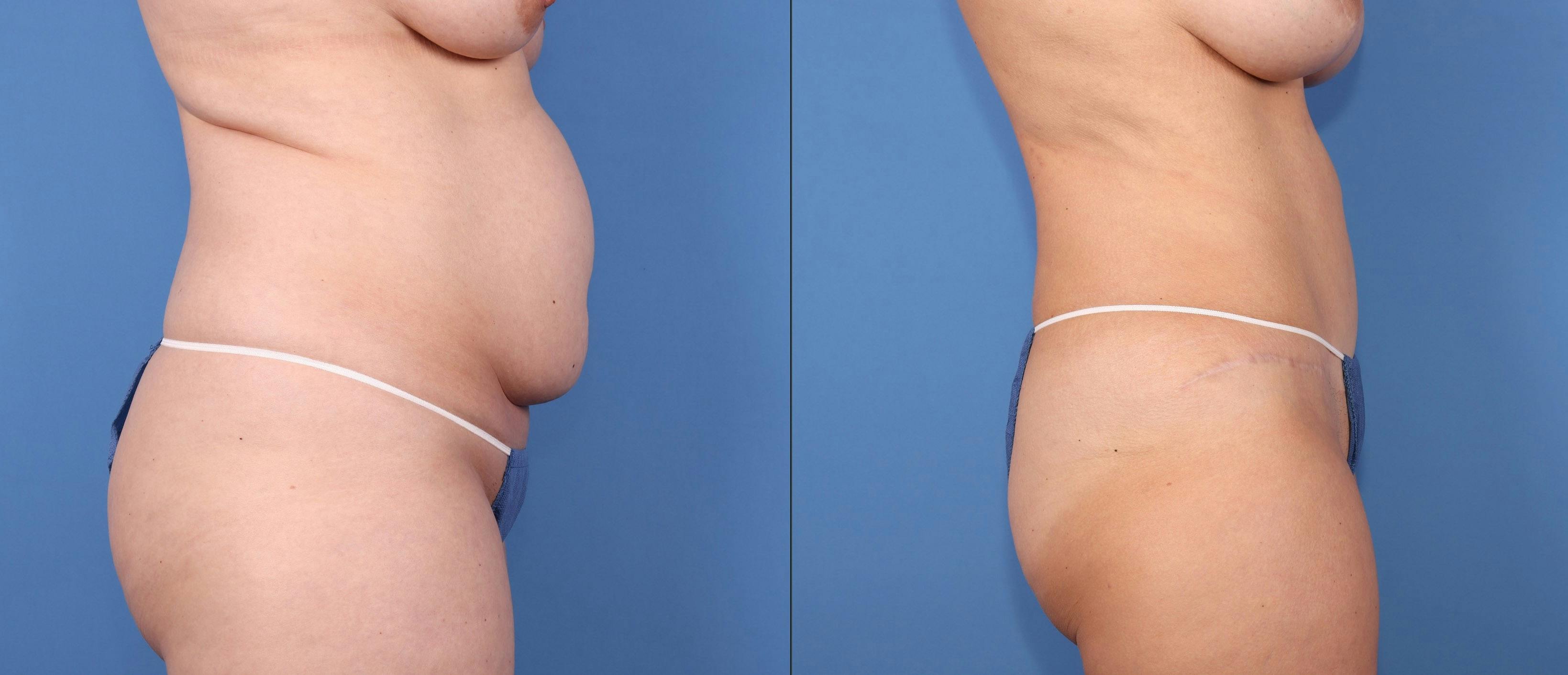 Abdomen Before & After Gallery - Patient 187164 - Image 3