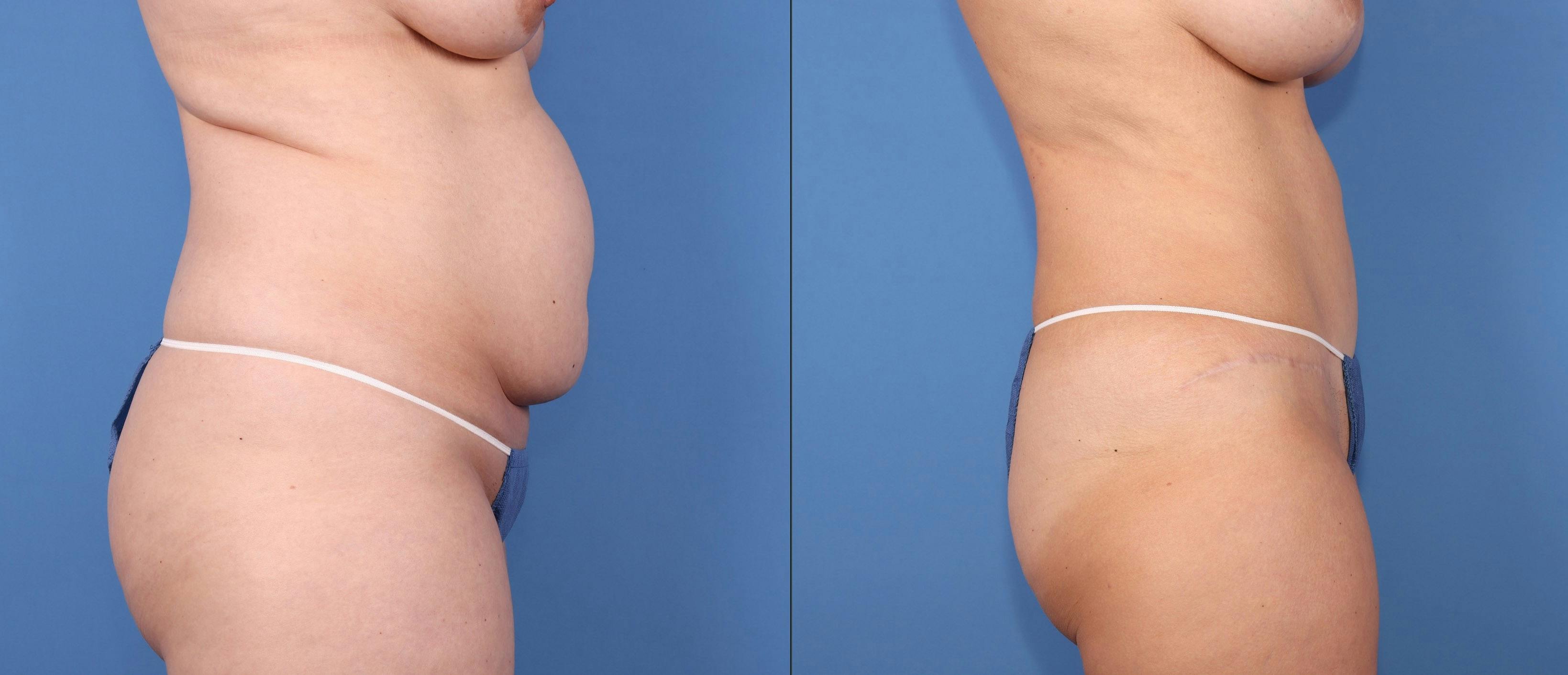 Tummy Tuck Before & After Gallery - Patient 126912 - Image 3