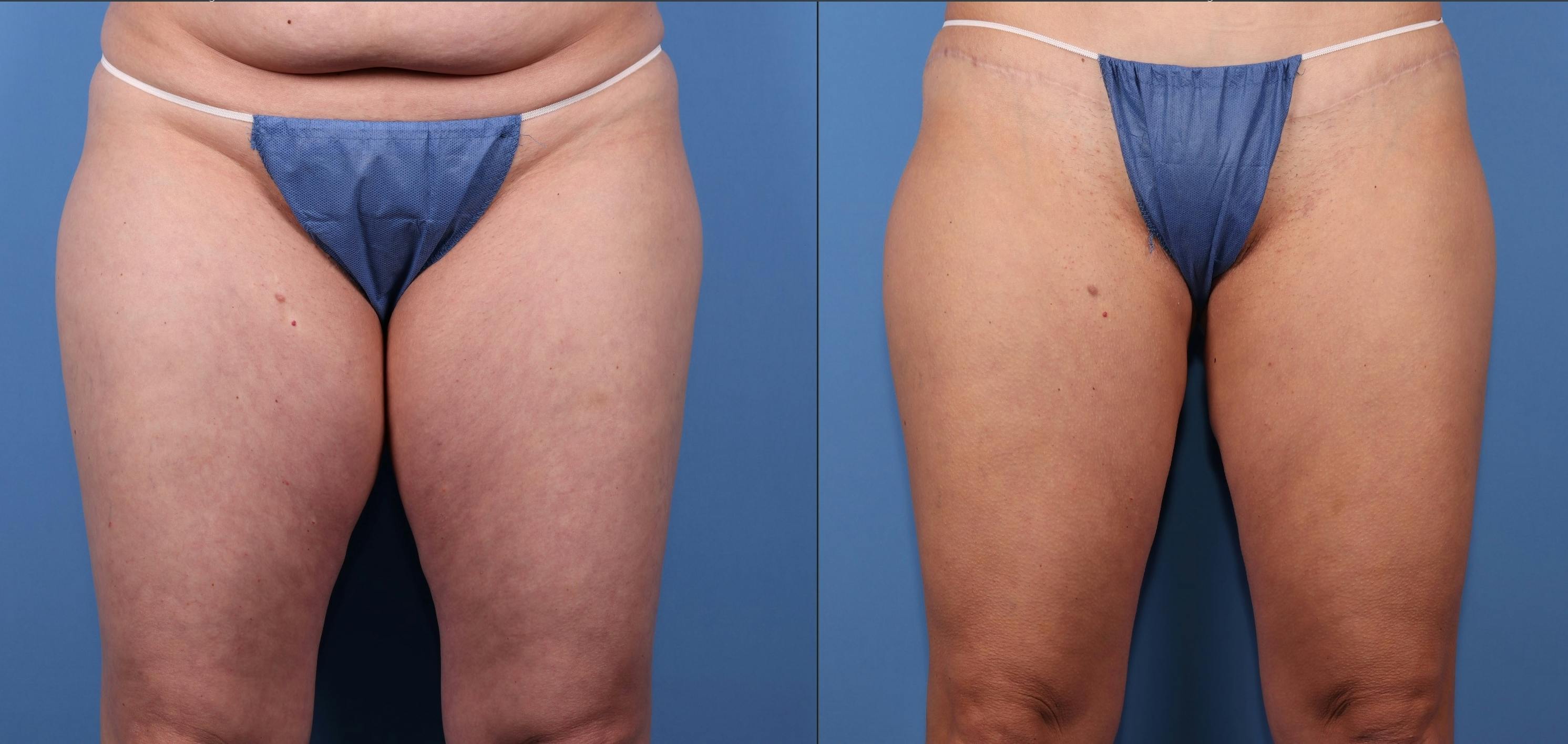 Thighs Before & After Gallery - Patient 277087 - Image 1
