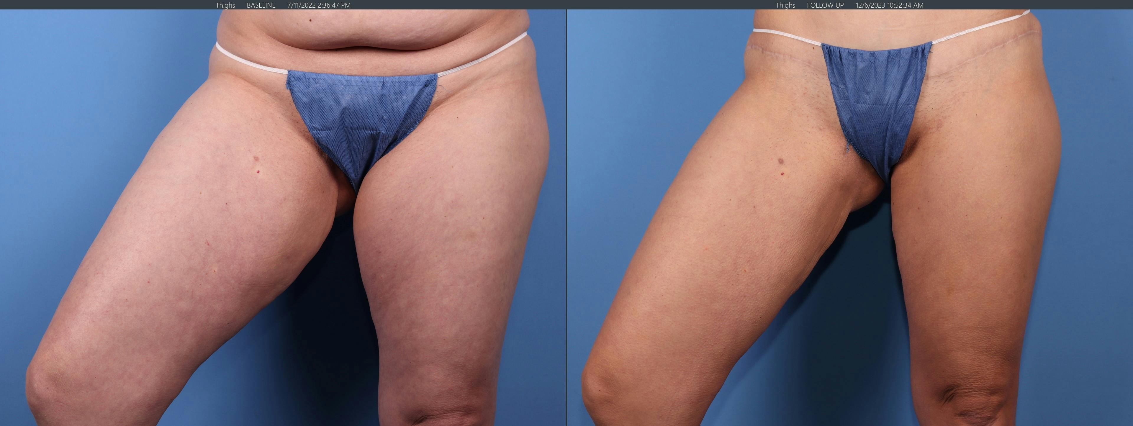 Thighs Before & After Gallery - Patient 277087 - Image 2