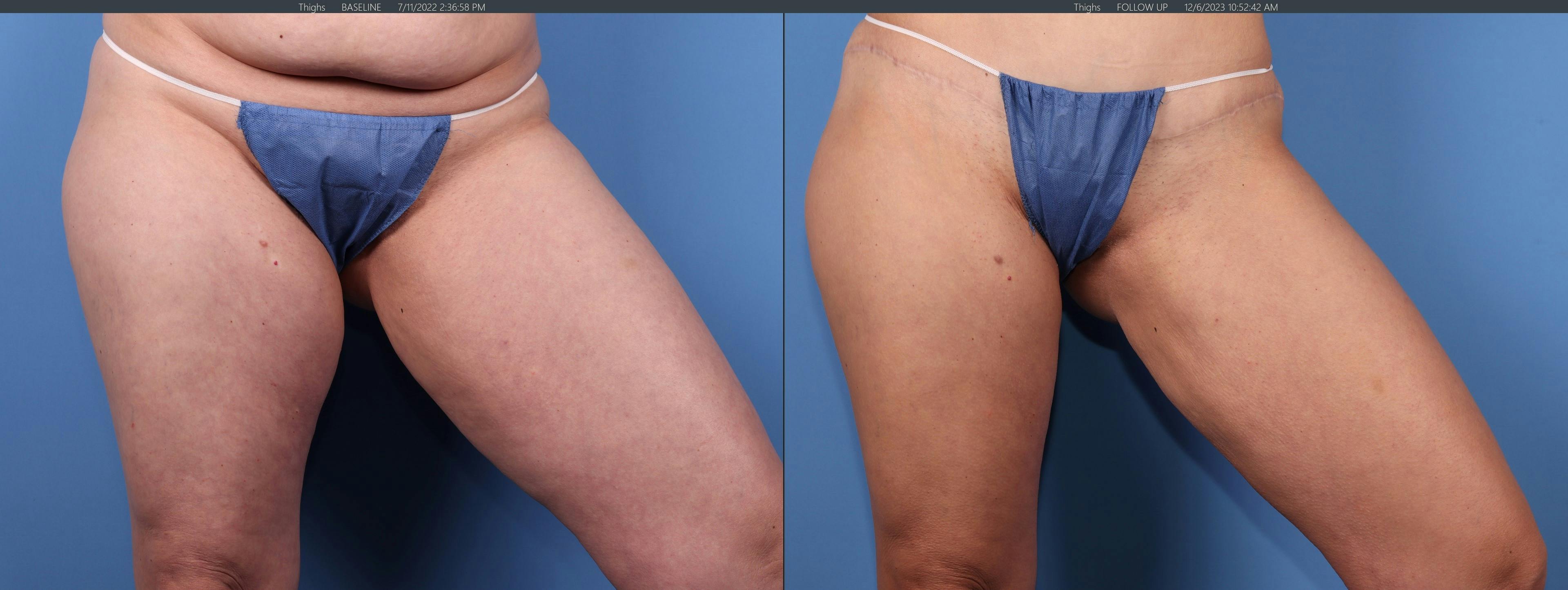 Thighs Before & After Gallery - Patient 277087 - Image 3