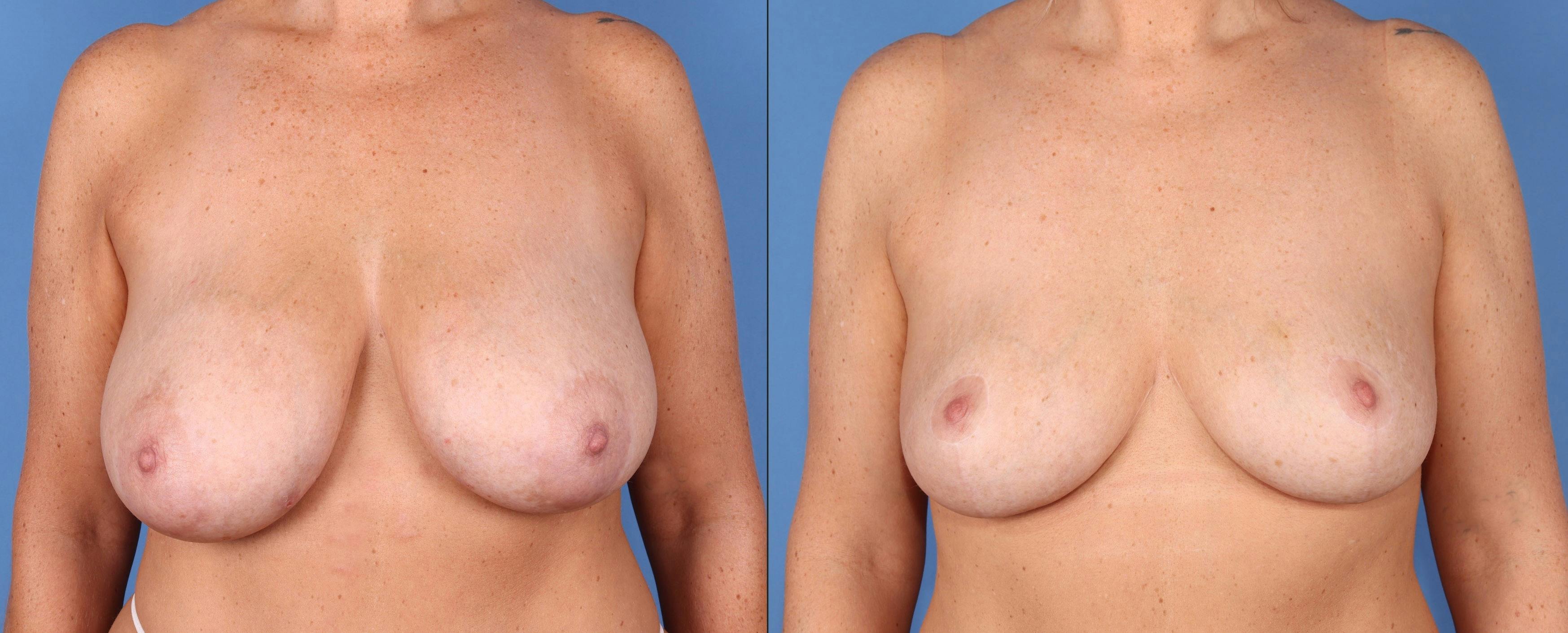 Breast Lift Before & After Gallery - Patient 224811 - Image 1