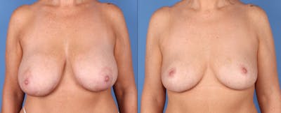 Breast Lift Before & After Gallery - Patient 224811 - Image 1