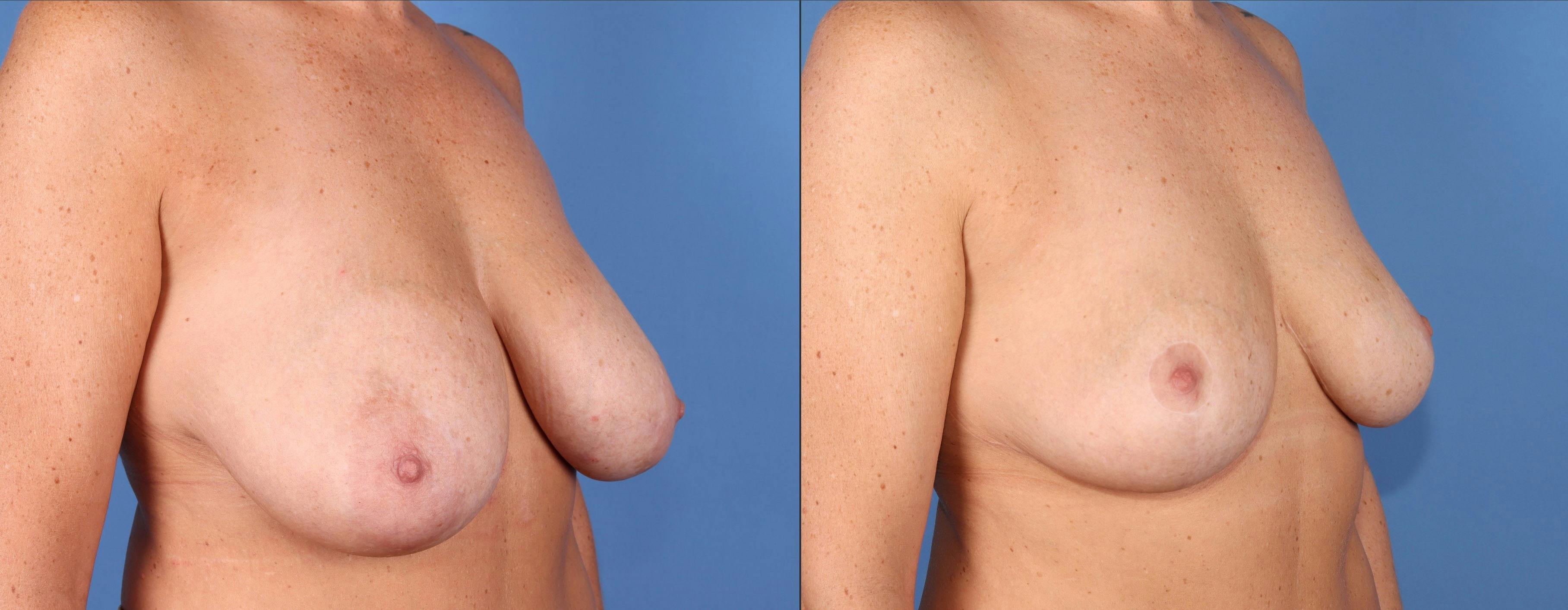Breast Lift Before & After Gallery - Patient 224811 - Image 2