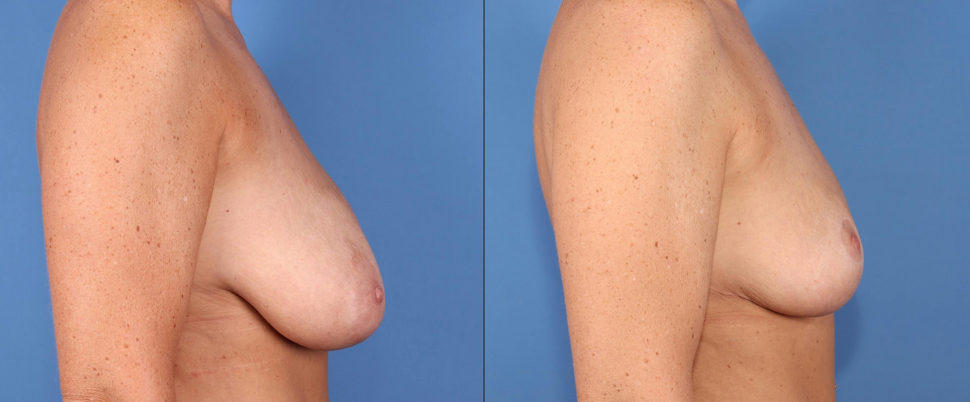 Breast Reduction Before & After Gallery - Patient 329485 - Image 3
