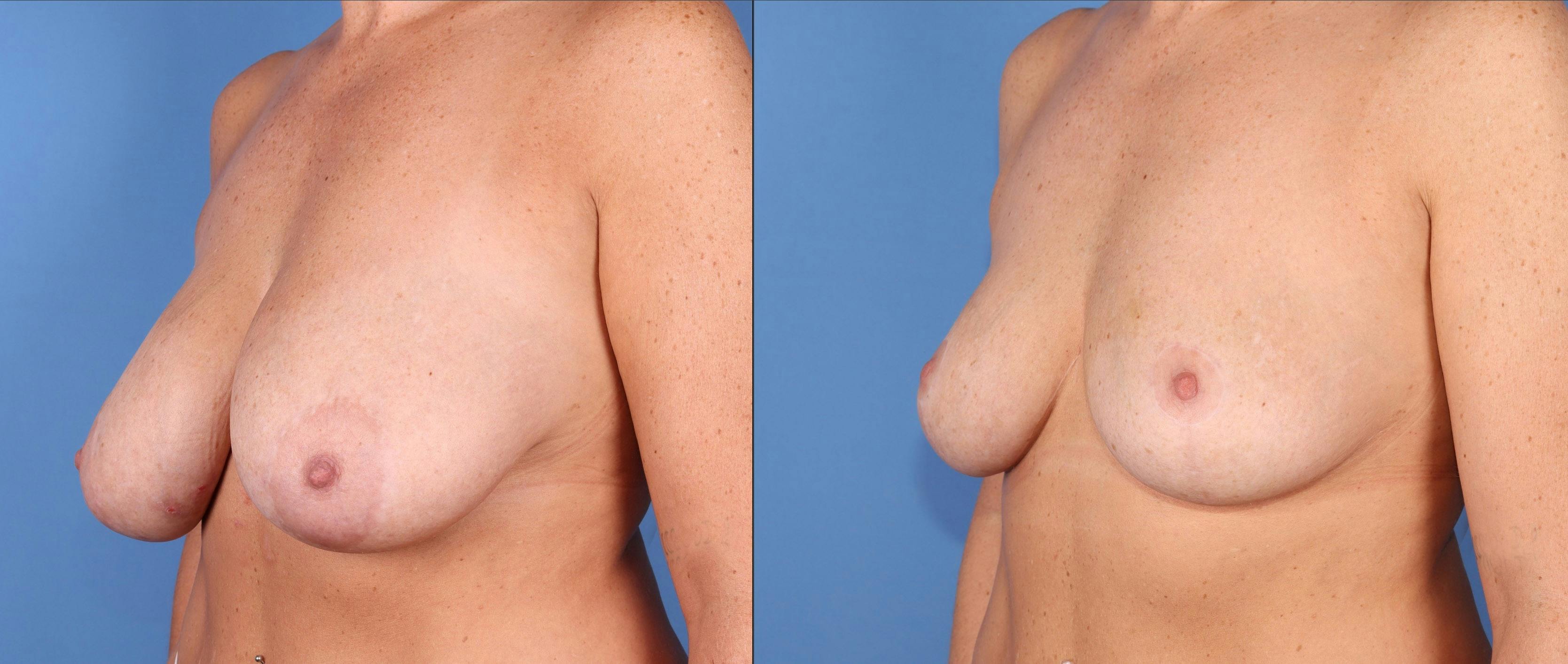 Breast Reduction Before & After Gallery - Patient 329485 - Image 4