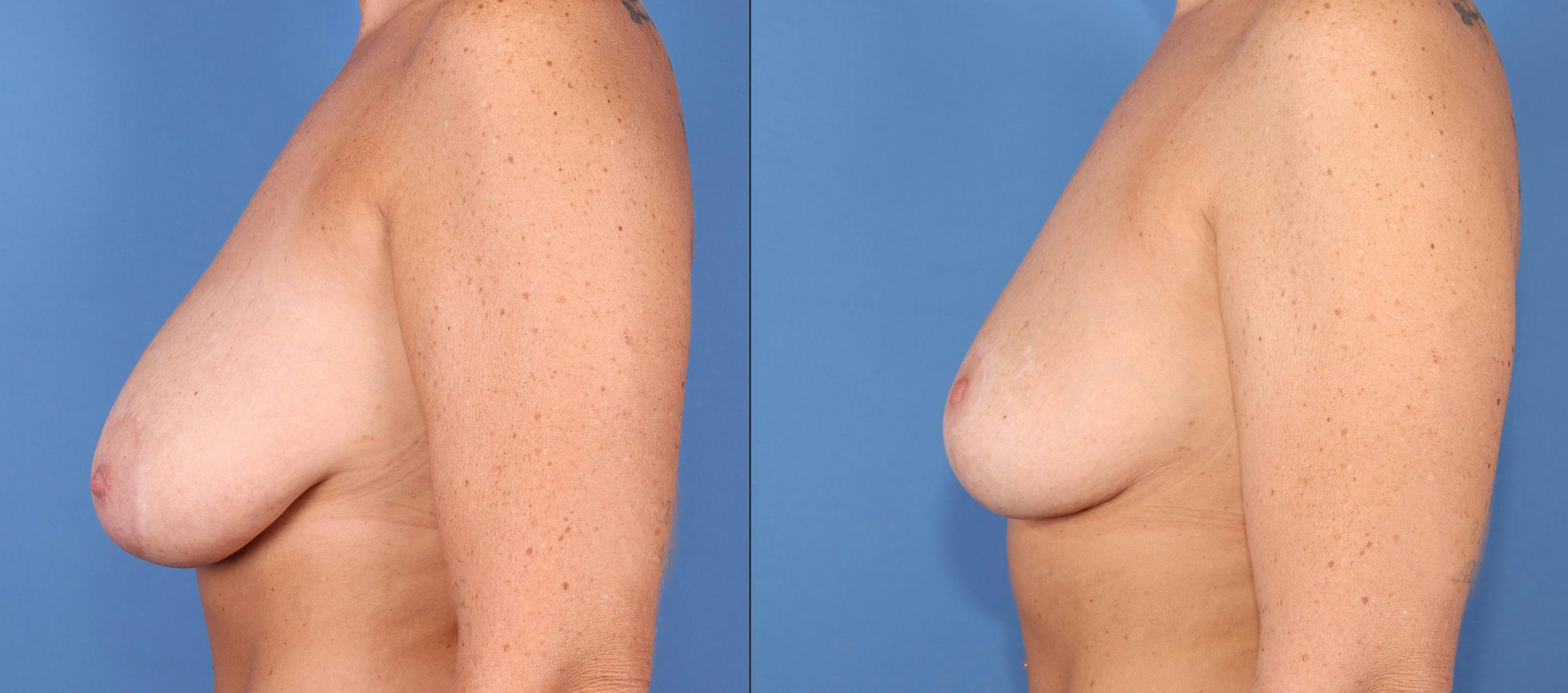Breast Reduction Before & After Gallery - Patient 329485 - Image 5