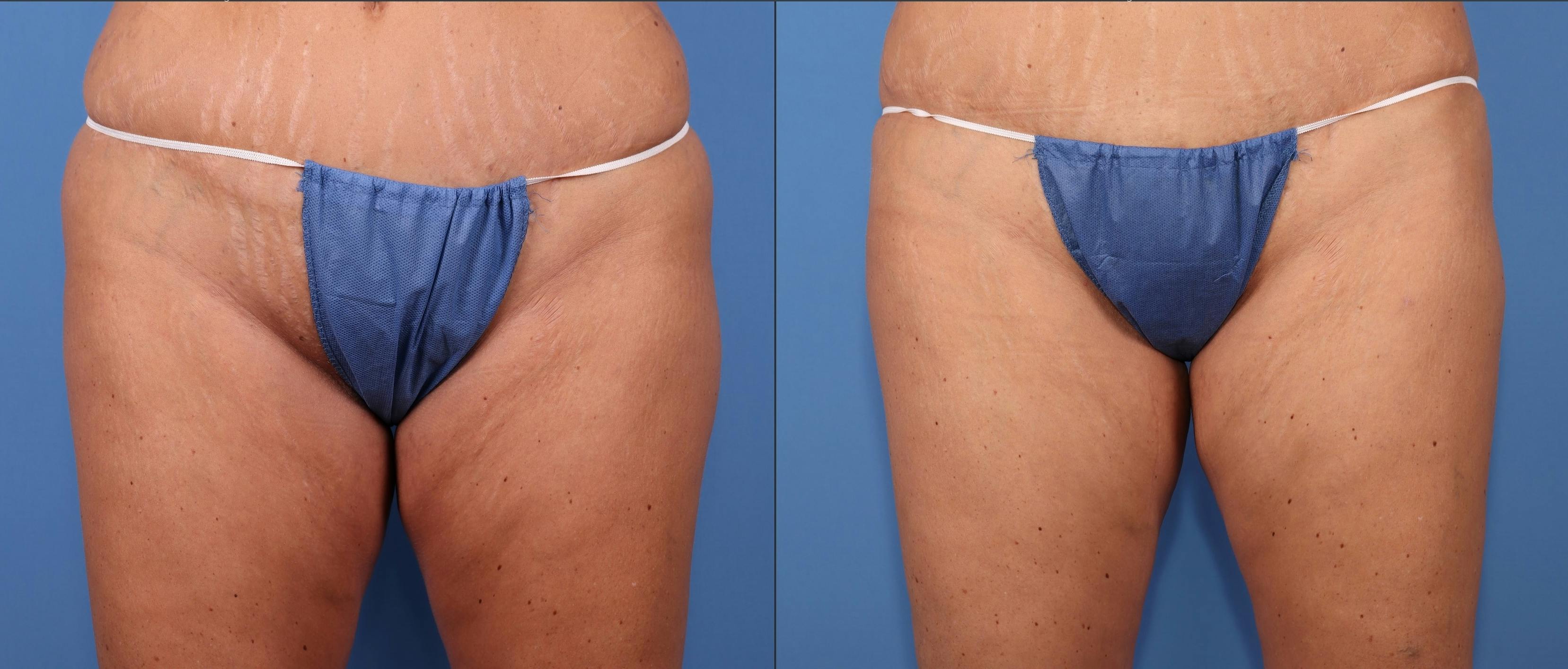 Thighs Before & After Gallery - Patient 107296 - Image 1