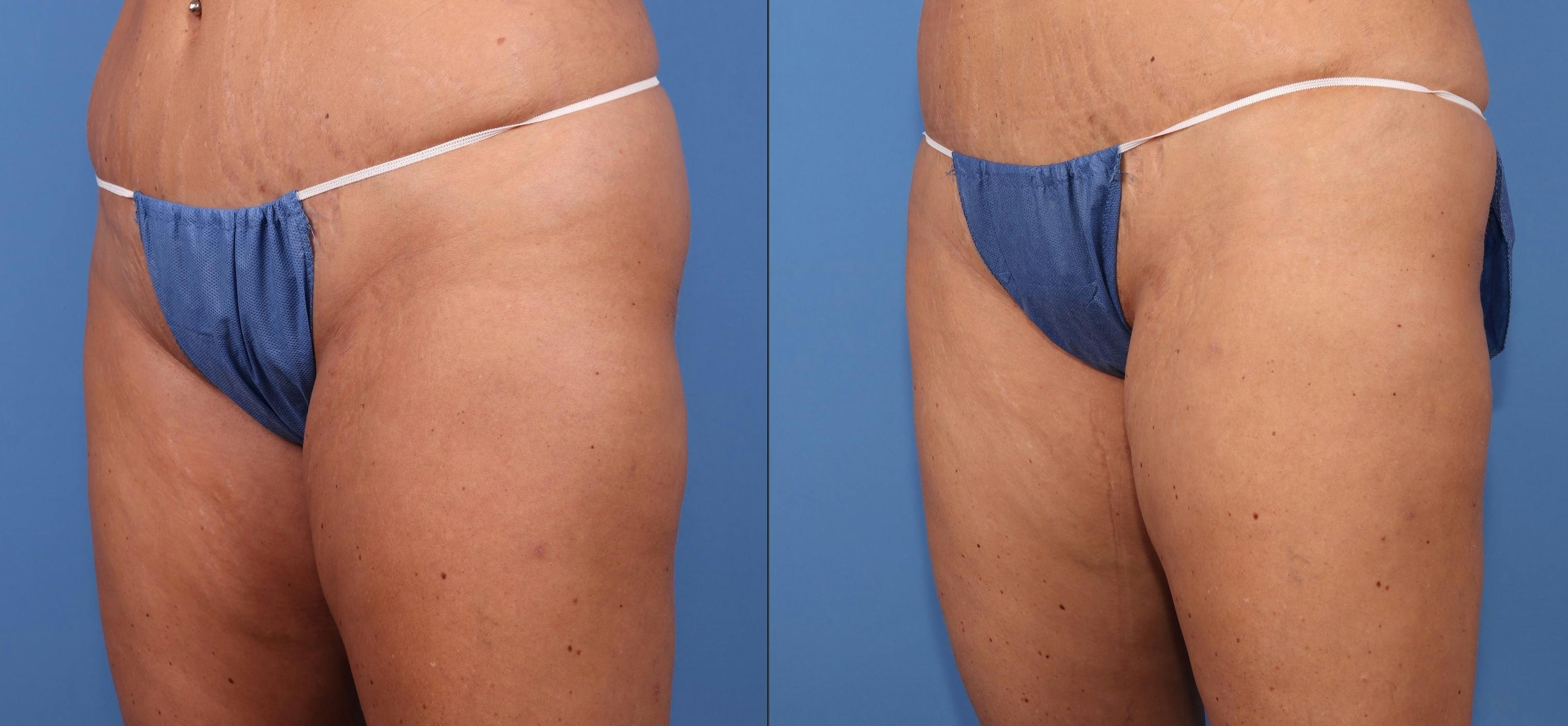 Thighs Before & After Gallery - Patient 107296 - Image 2