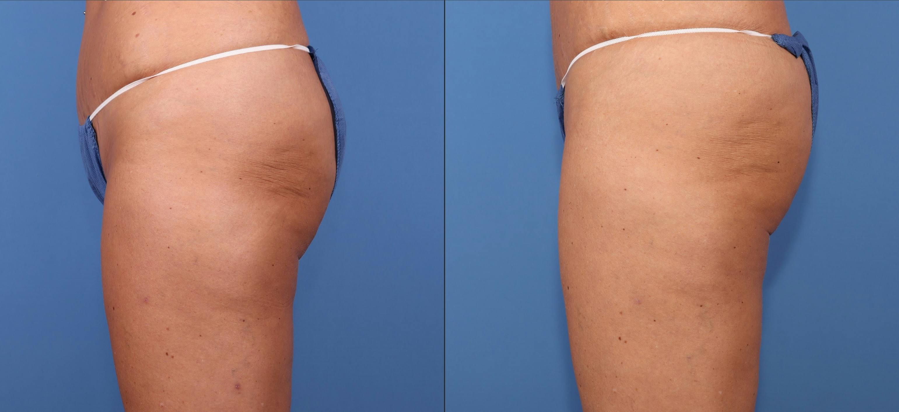 Thighs Before & After Gallery - Patient 107296 - Image 3