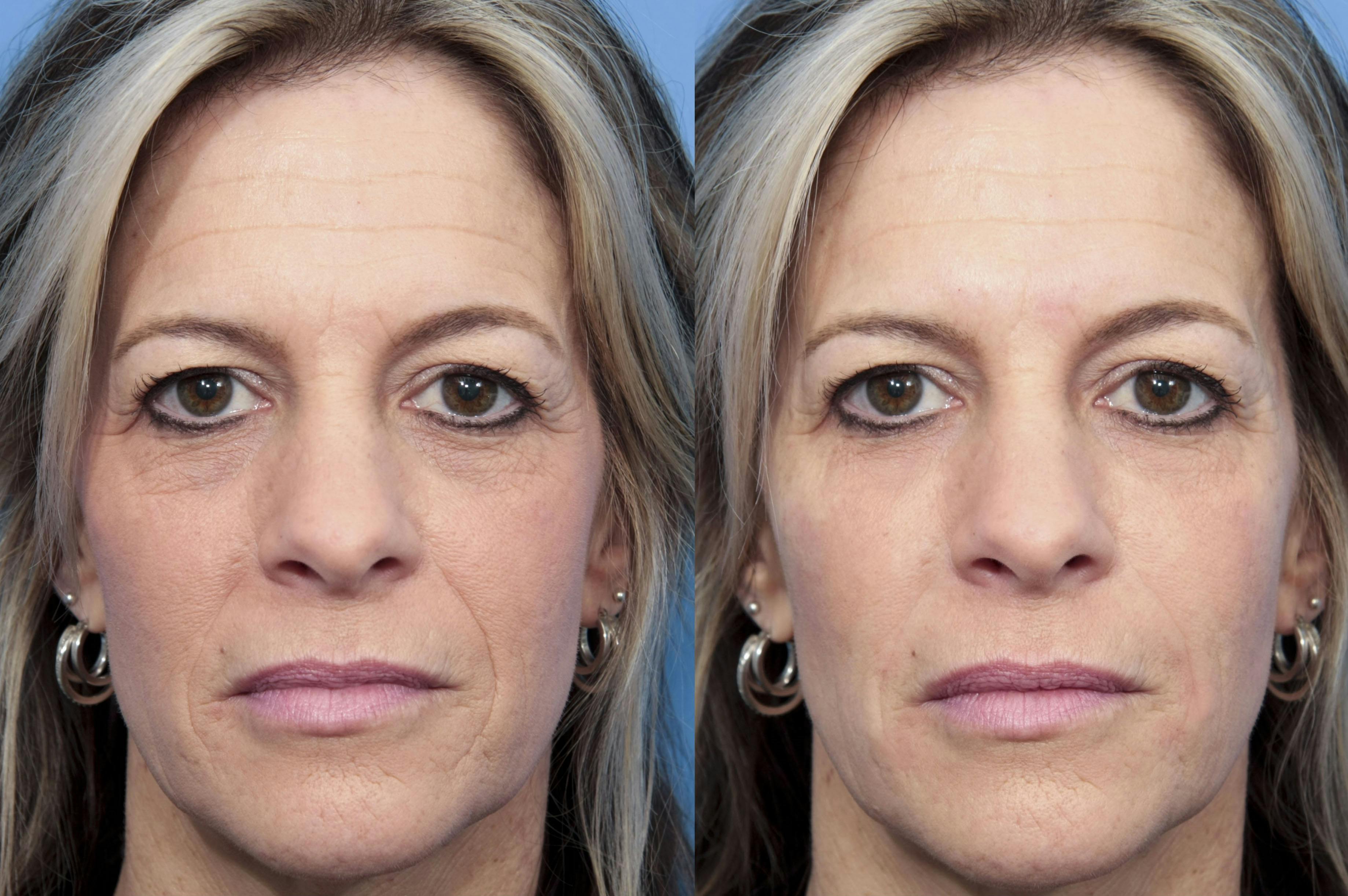 Facial Fillers Before & After Gallery - Patient 343661 - Image 1