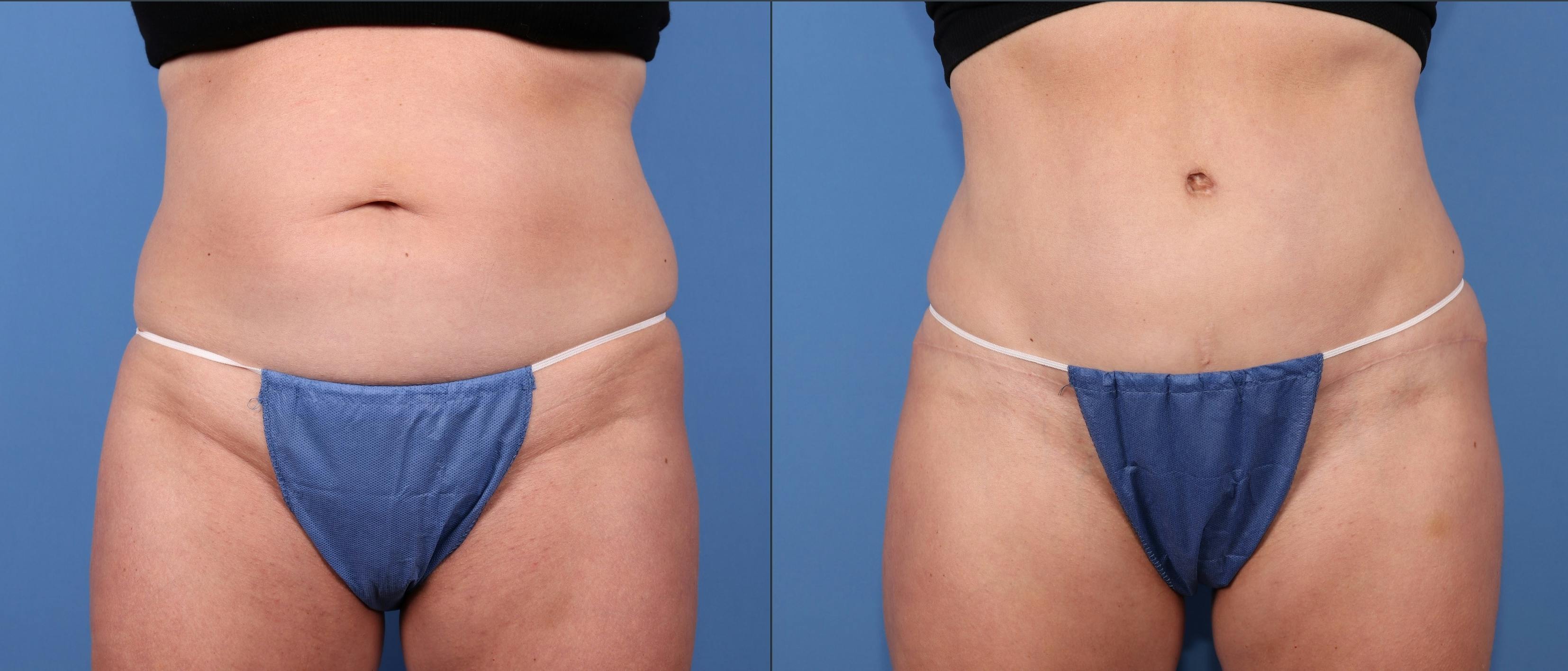 Abdomen Before & After Gallery - Patient 163264 - Image 1