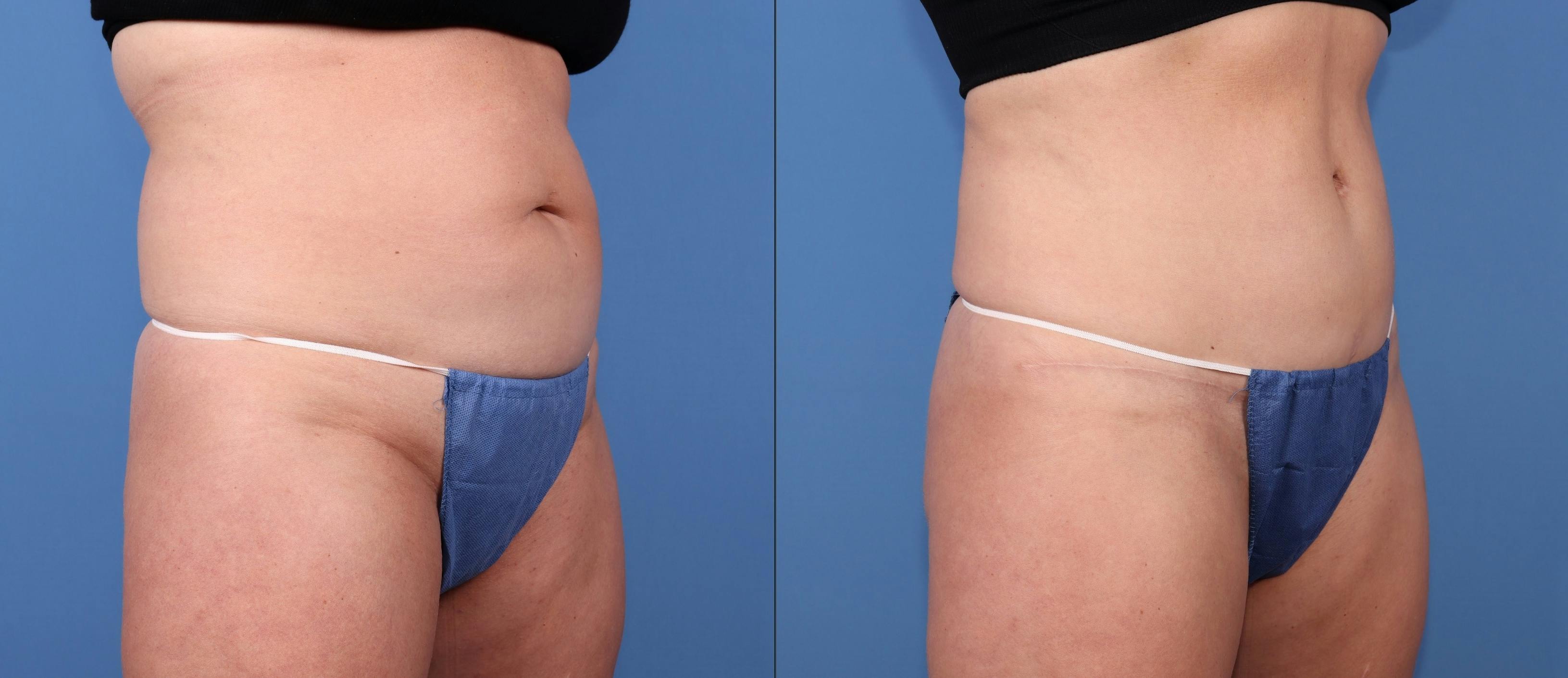 Tummy Tuck Before & After Gallery - Patient 175690 - Image 2