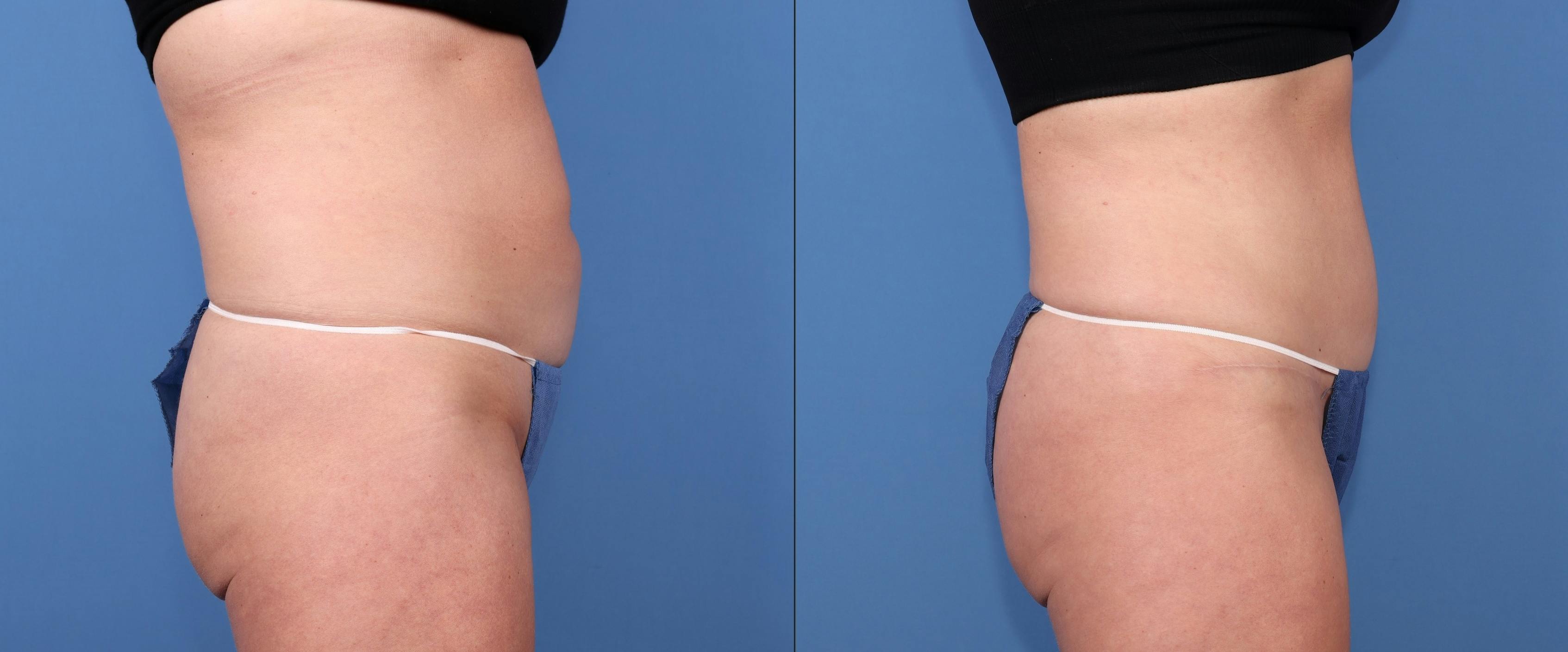 Abdomen Before & After Gallery - Patient 163264 - Image 3
