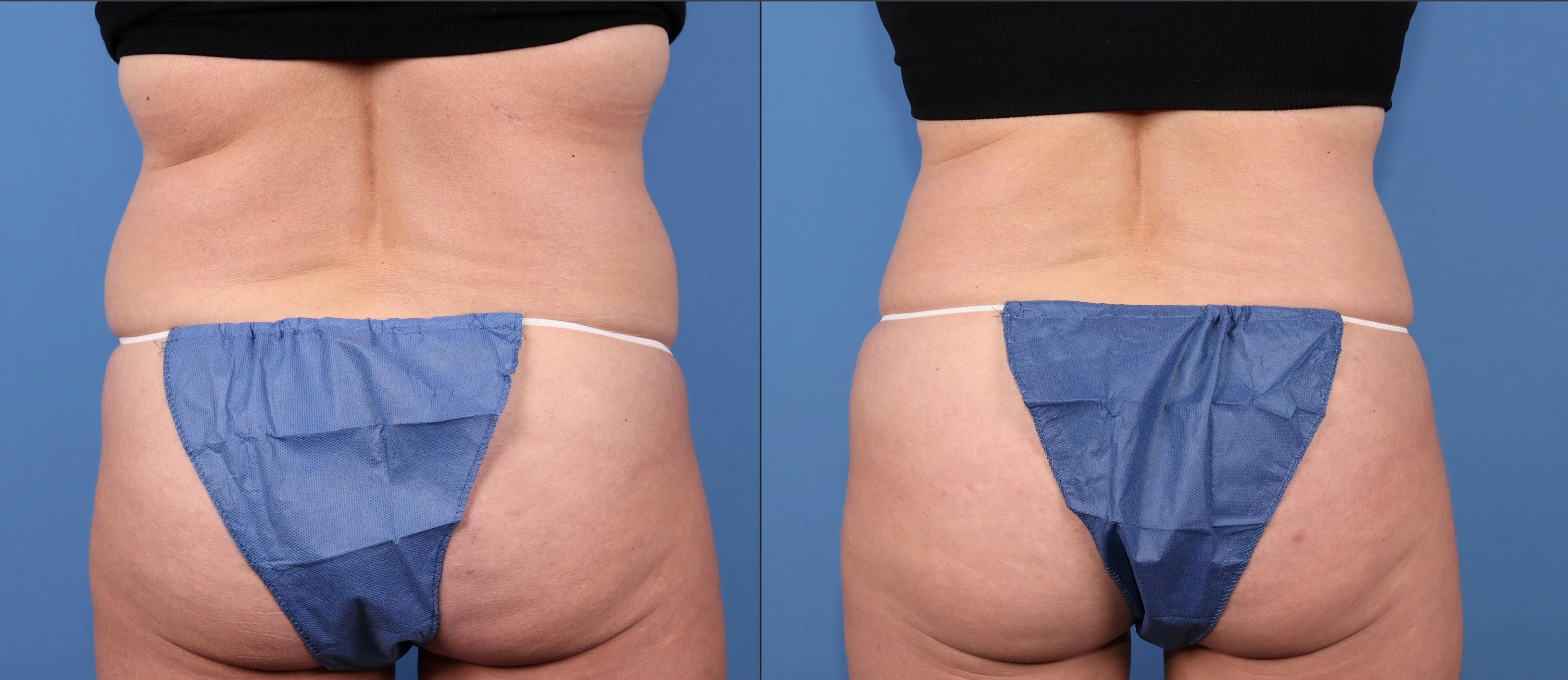 Abdomen Before & After Gallery - Patient 163264 - Image 4