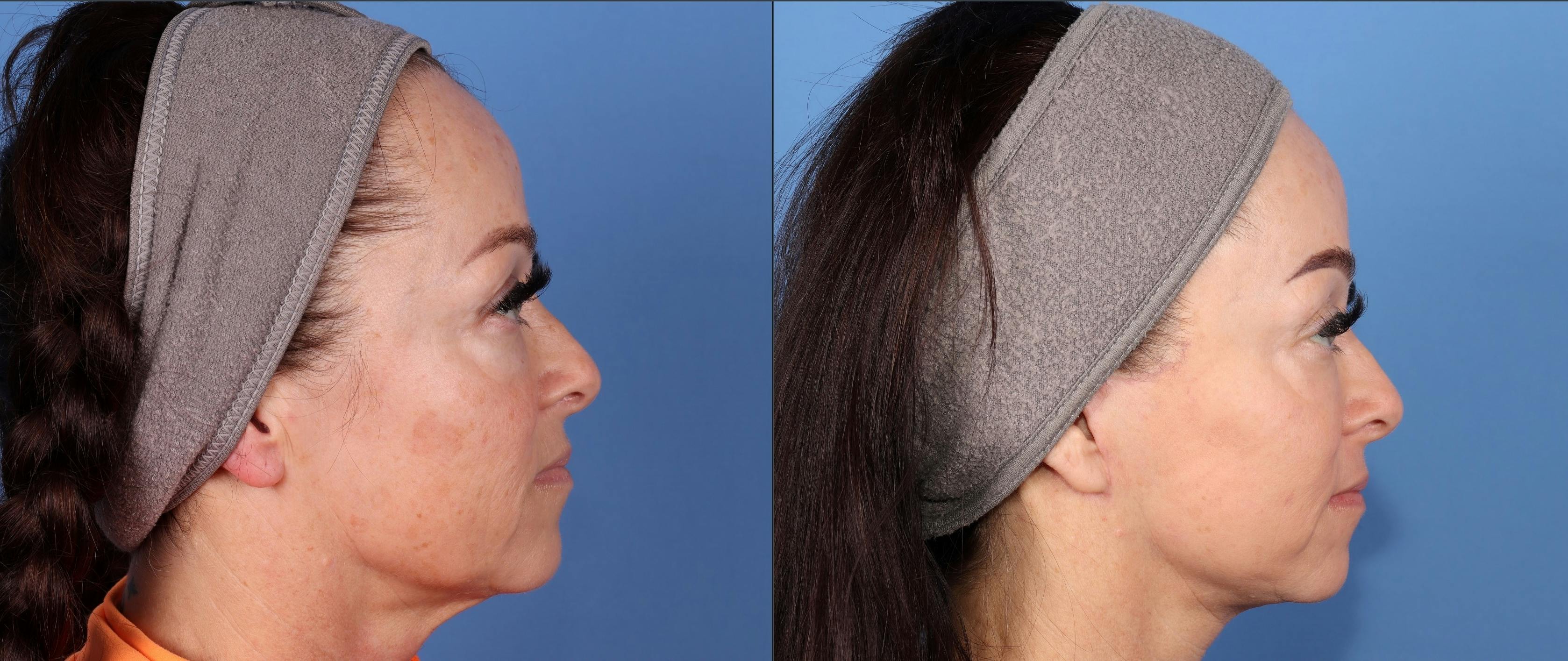 Contour TRL Laser Before & After Gallery - Patient 124305 - Image 3
