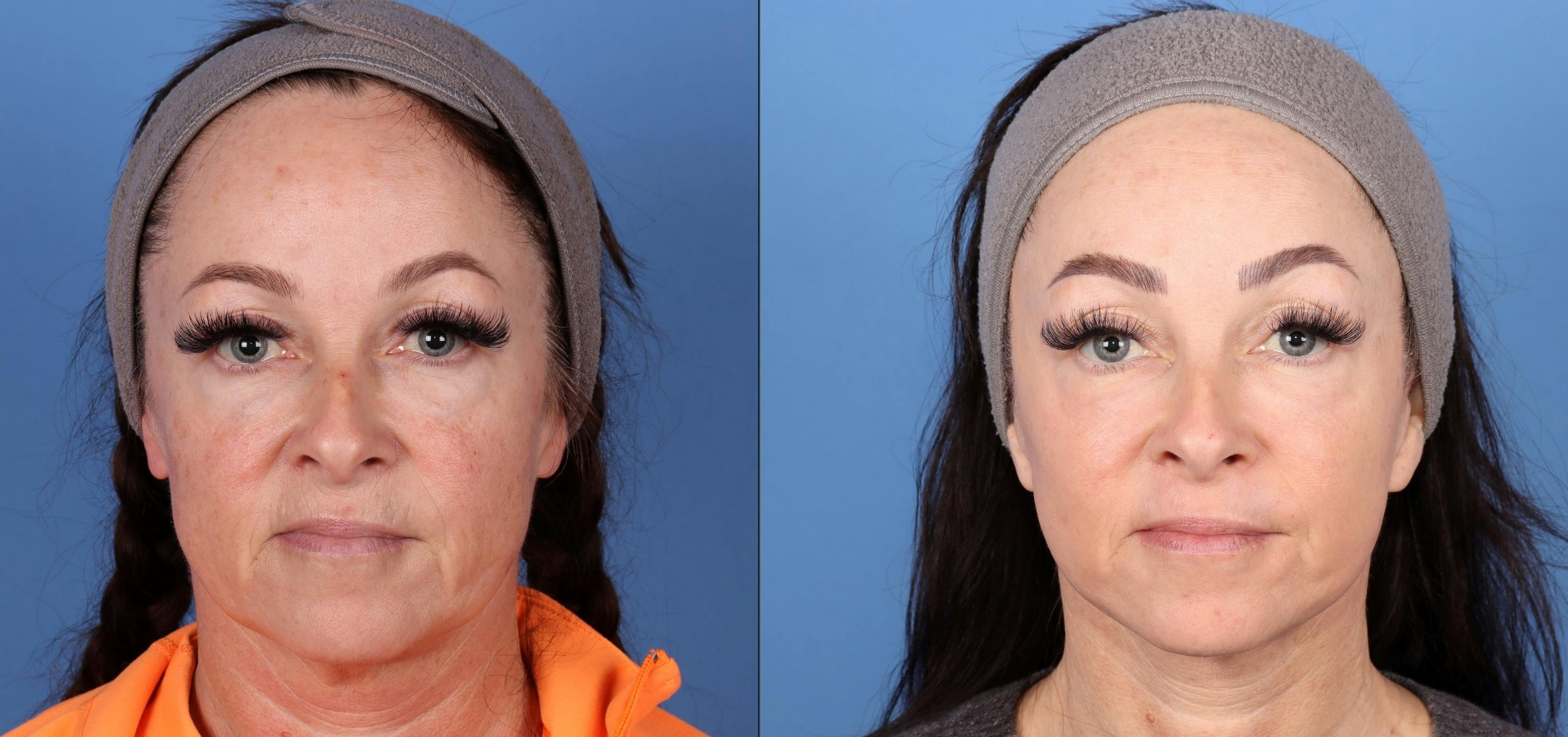 Mini Facelift Before & After Gallery - Patient 365841 - Image 1