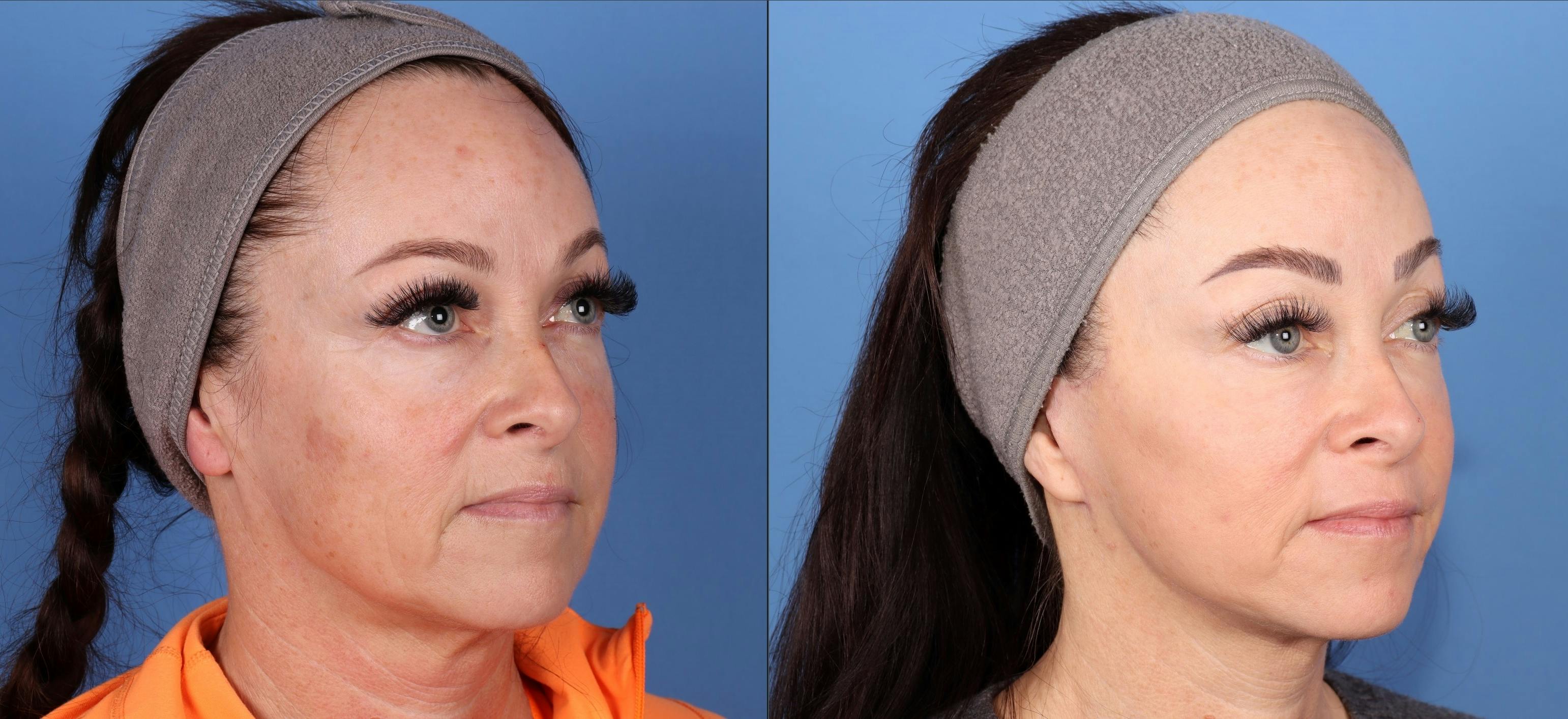 Contour TRL Laser Before & After Gallery - Patient 124305 - Image 2