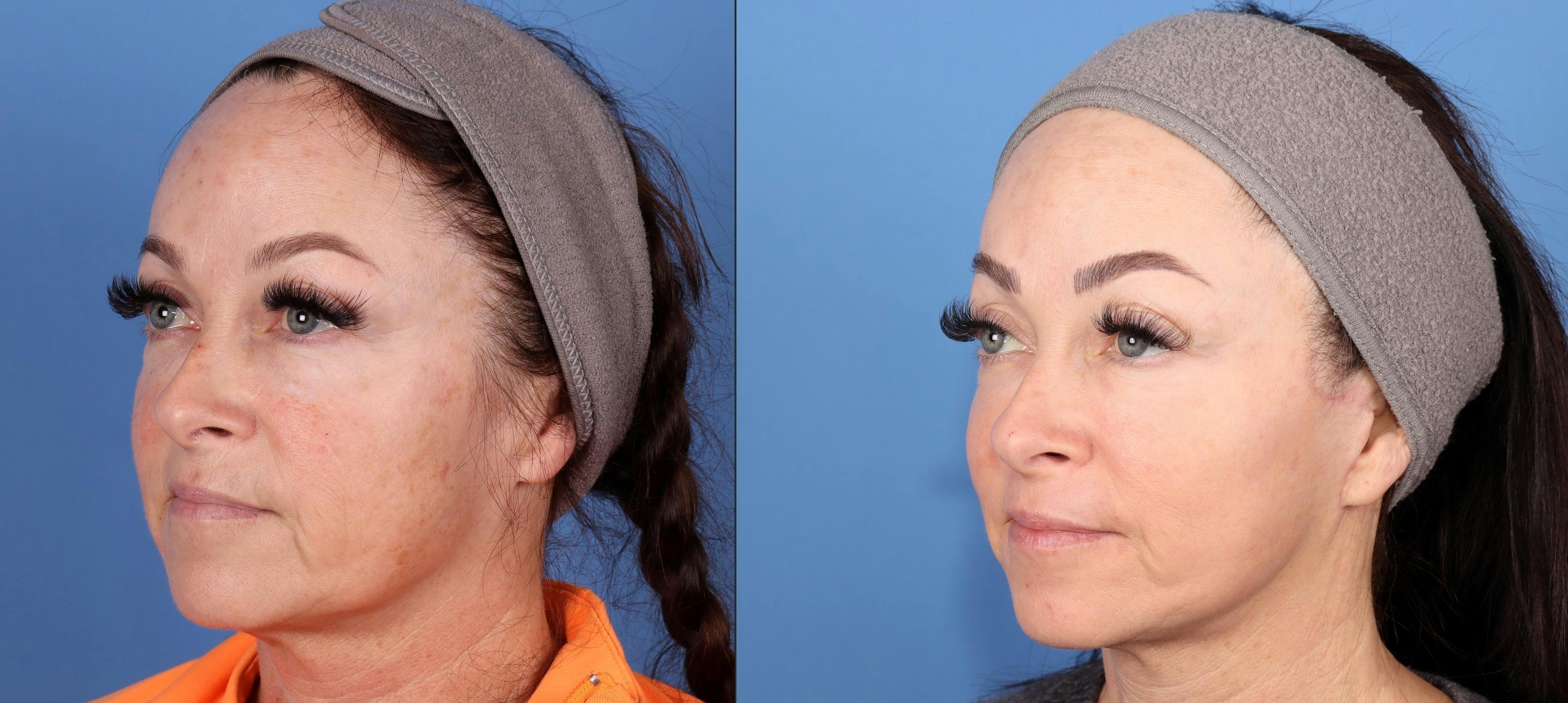 Contour TRL Laser Before & After Gallery - Patient 124305 - Image 4