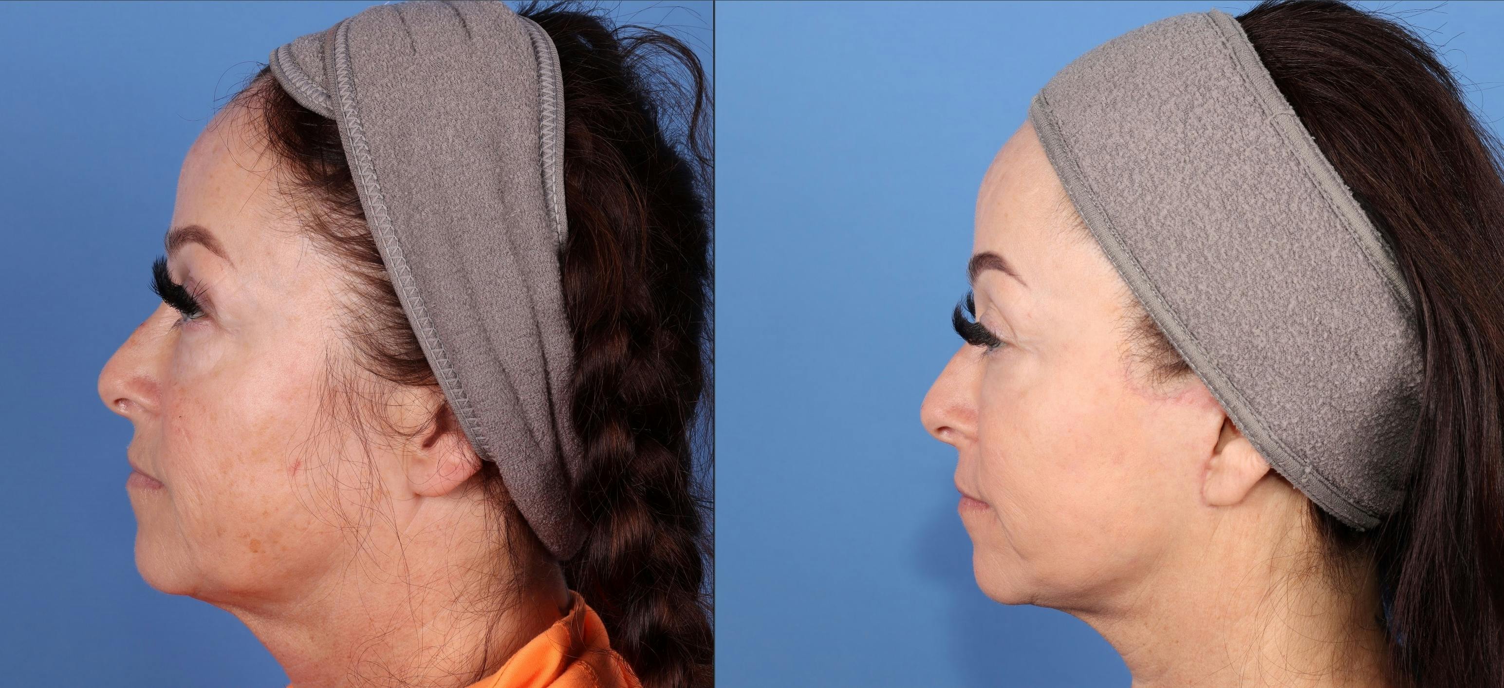 Mini Facelift Before & After Gallery - Patient 365841 - Image 5