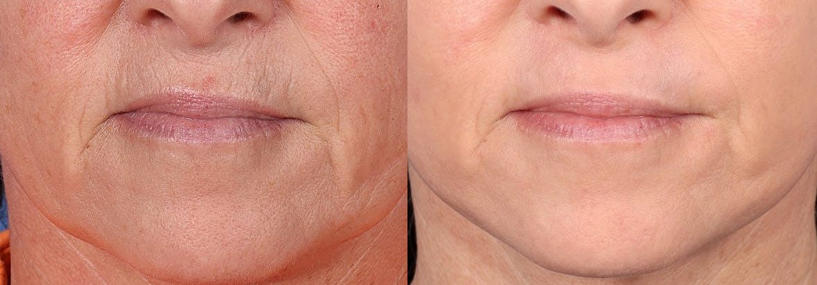 Contour TRL Laser Before & After Gallery - Patient 124305 - Image 6