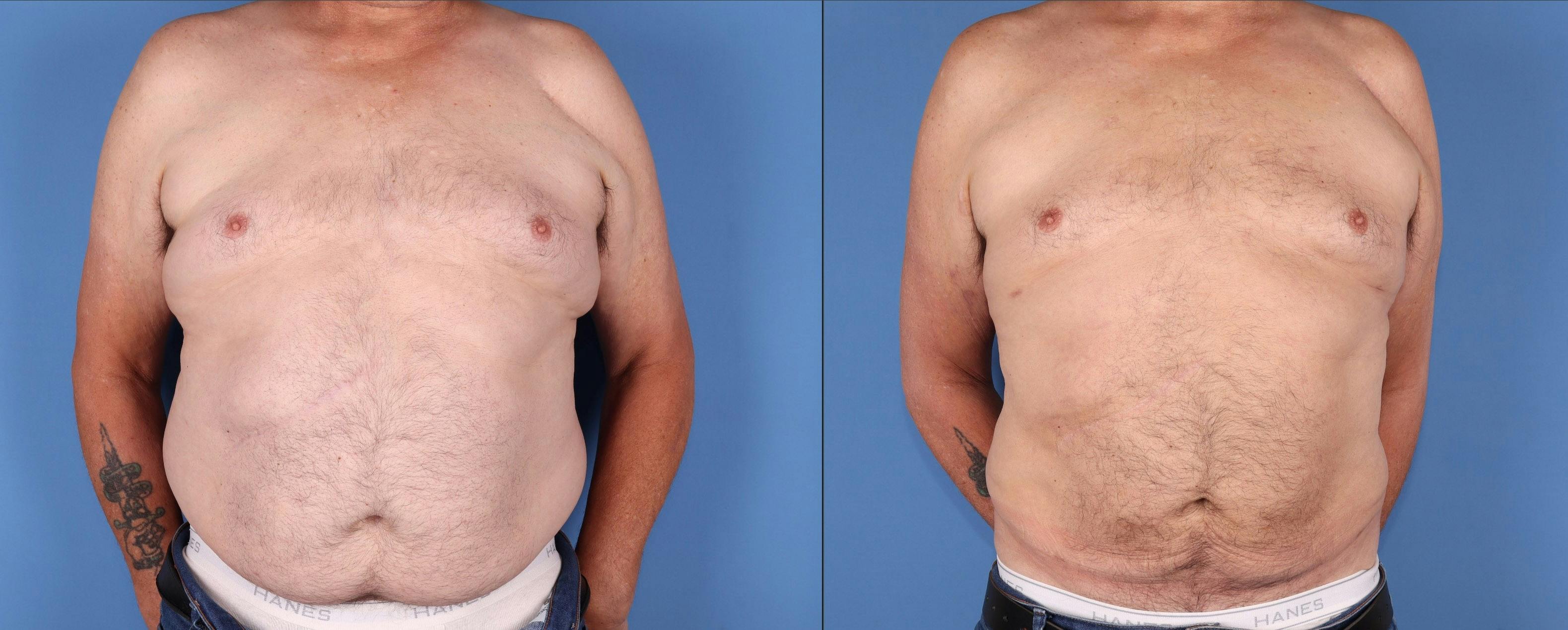 Abdomen Before & After Gallery - Patient 328709 - Image 1