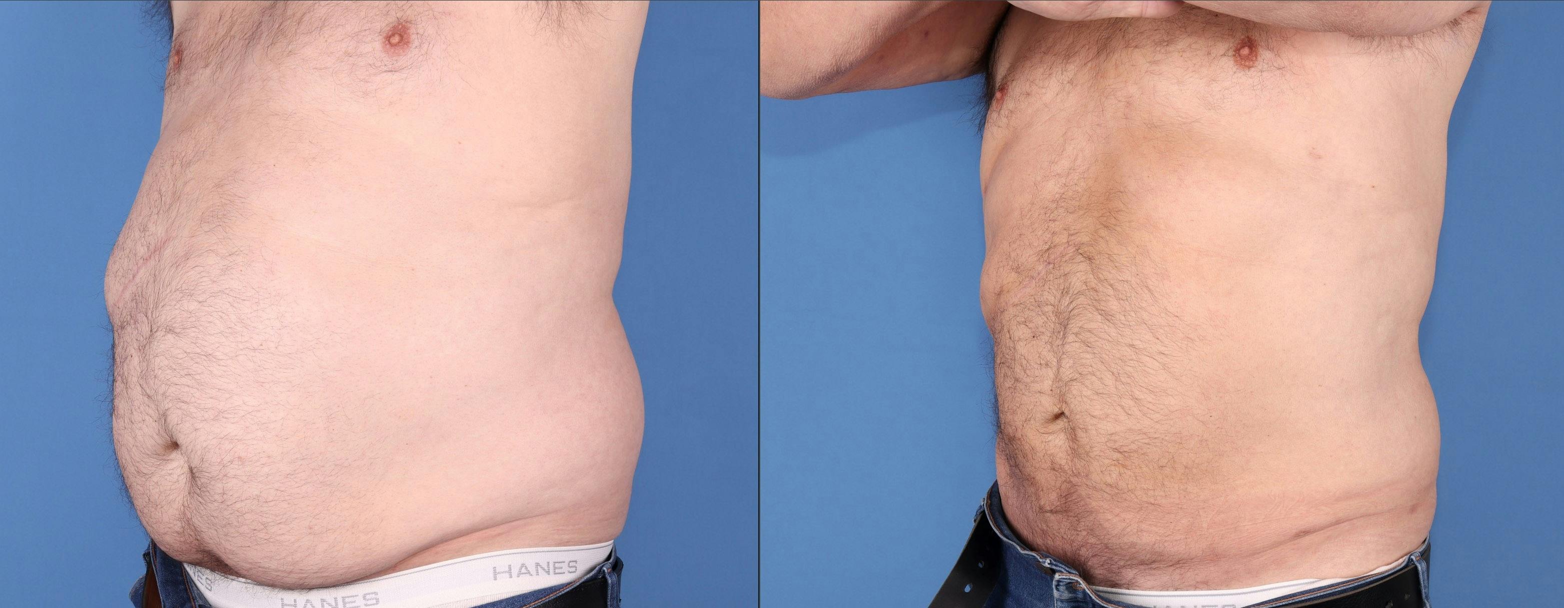 Abdomen Before & After Gallery - Patient 328709 - Image 3